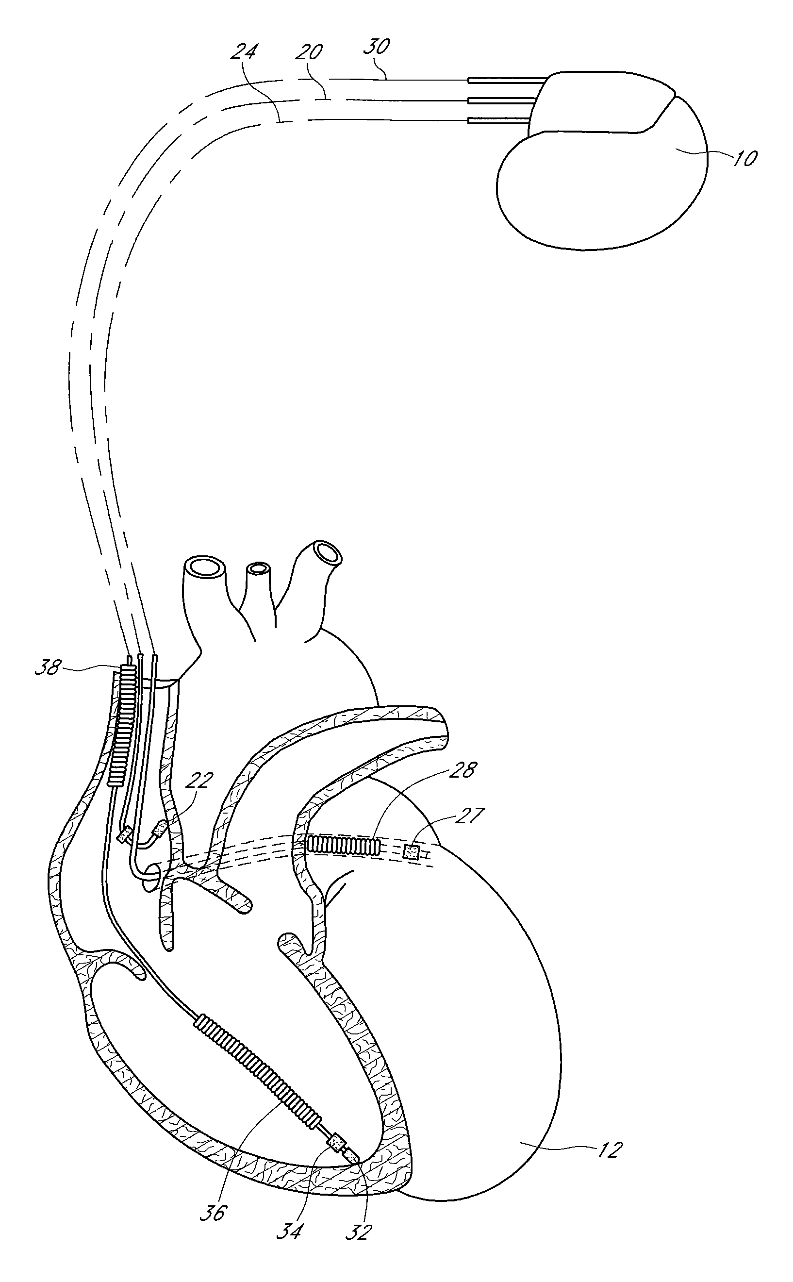 Identification of electro-mechanical dysynchrony with a non-cardiac resynchronization therapeutic device