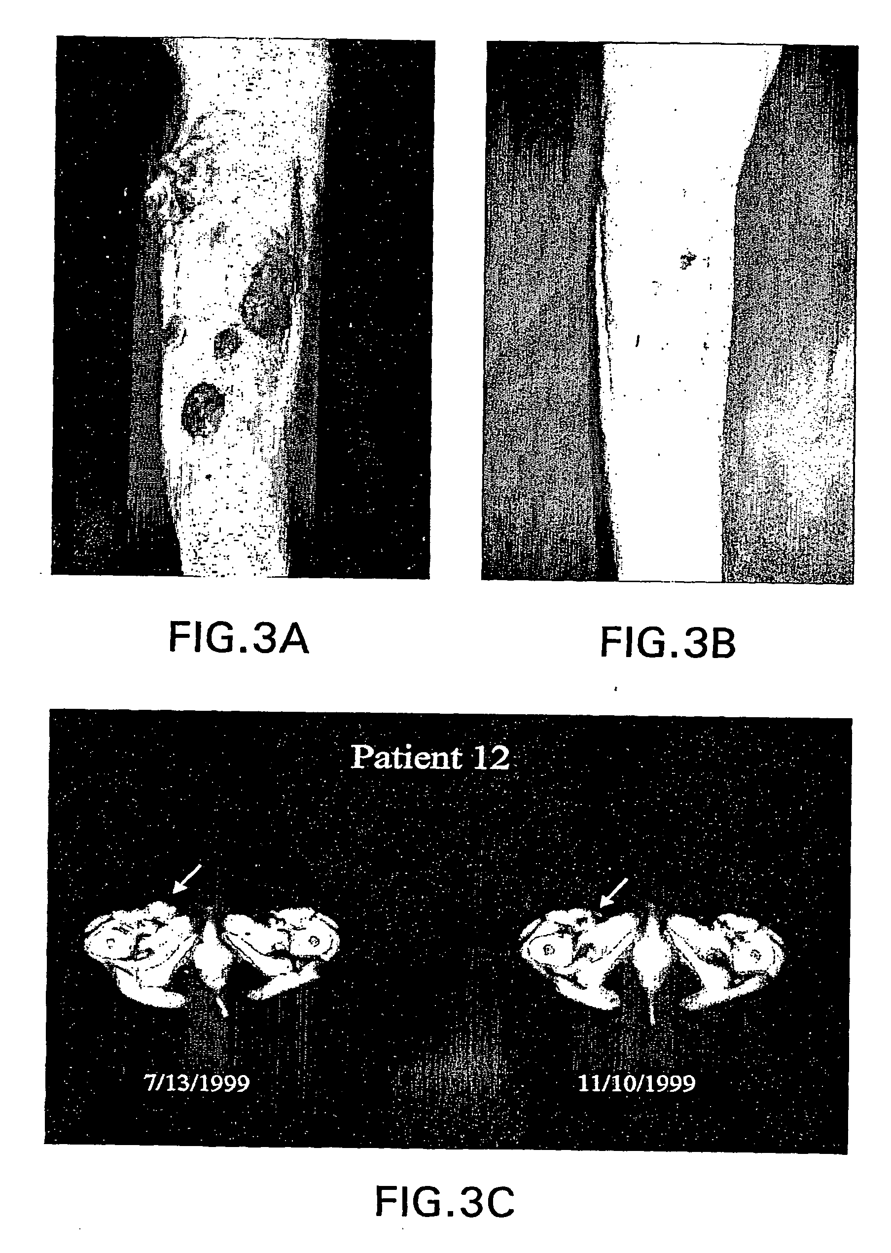 Methods of treatment of a bcl-2 disorder using bcl-2 antisense oligomers