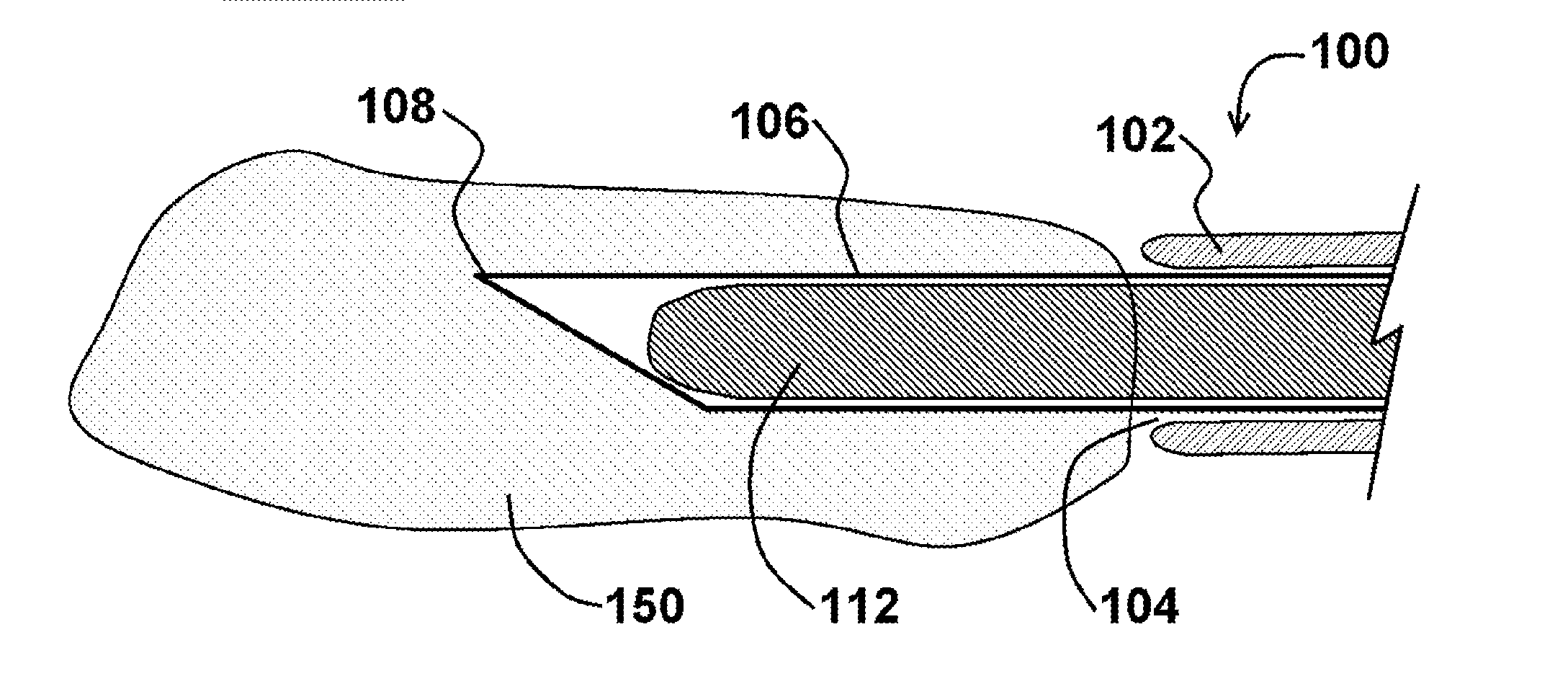 Method for access needle with pre-loaded wire guide and device