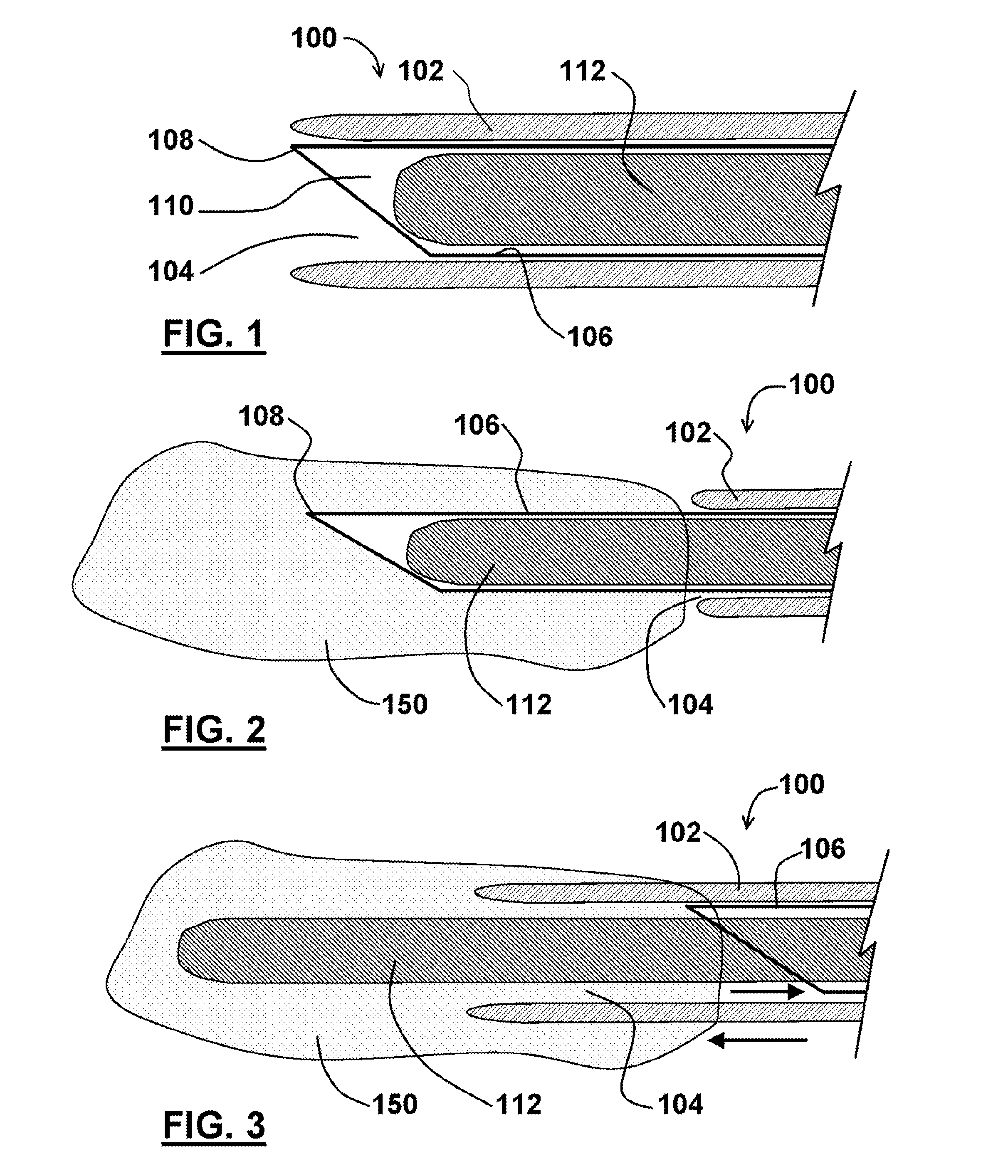 Method for access needle with pre-loaded wire guide and device