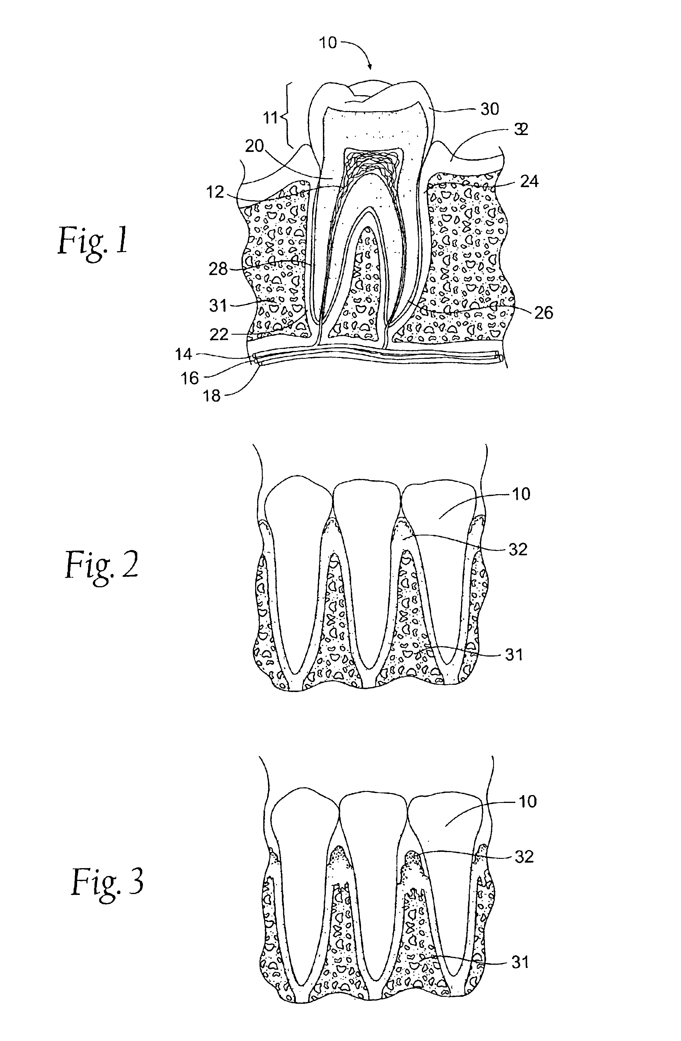 Expandable polymer dental implant and method of use