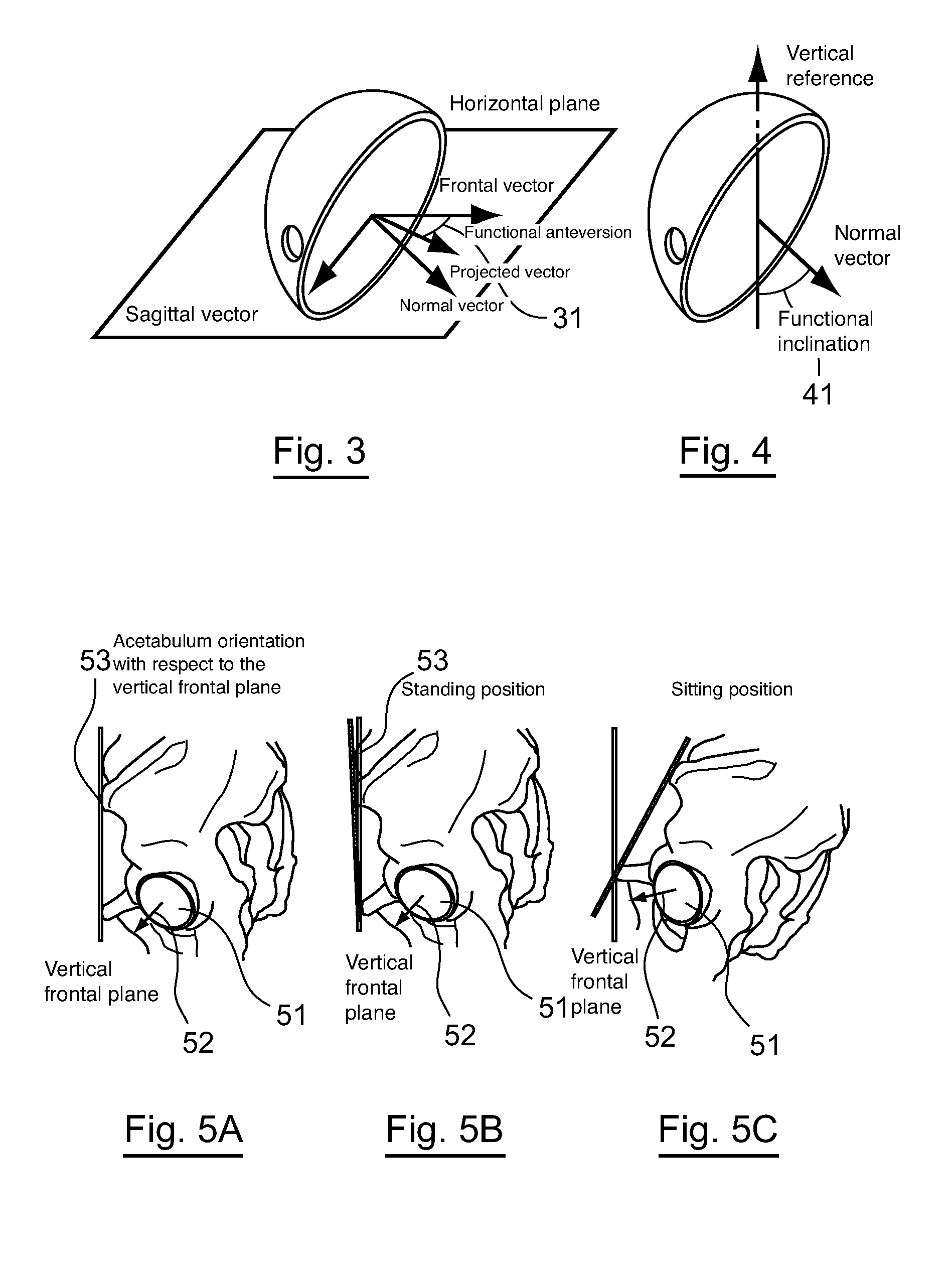 Help system for implanting a hip prosthesis on an individual