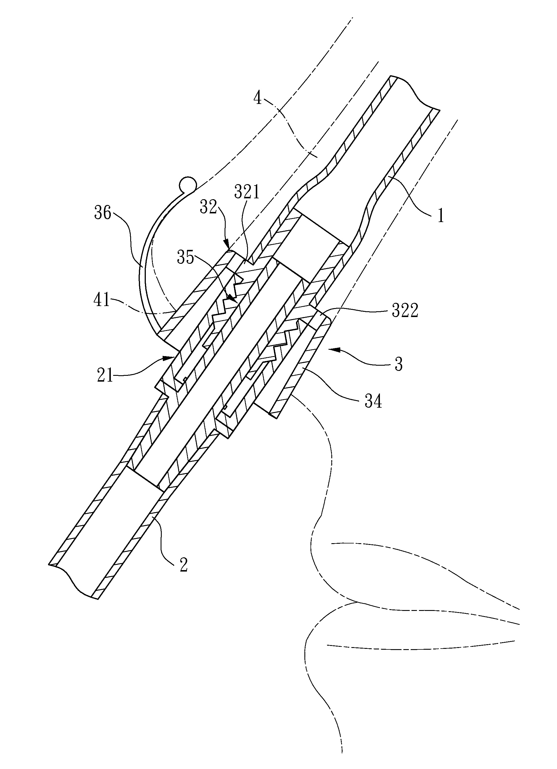 Nasogastric Tube