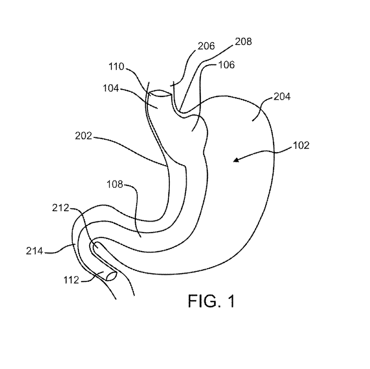 Gastric bypass device
