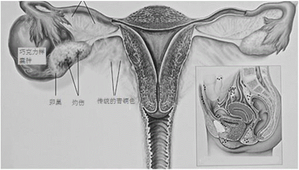 Application of Maqian essential oil in preparation of medicine for preventing and treating endometriosis