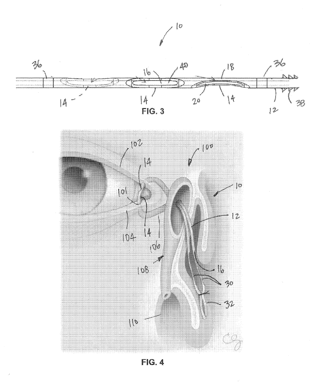 Lacrimal stent with opening