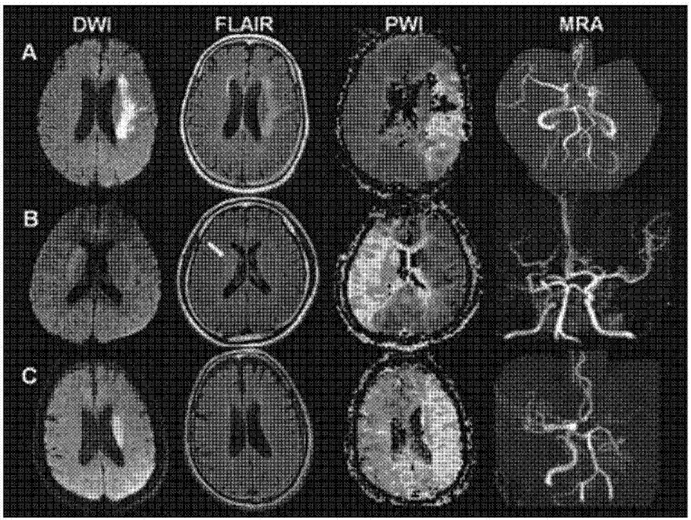 Method for estimating time of occurrence of infarct region on basis of brain image