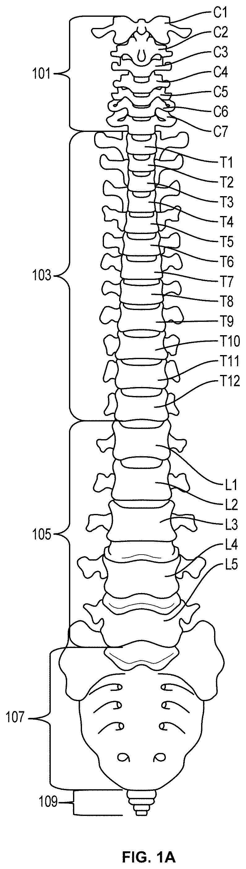 Systems and Methods for Relieving Nerve Tension in Scoliosis