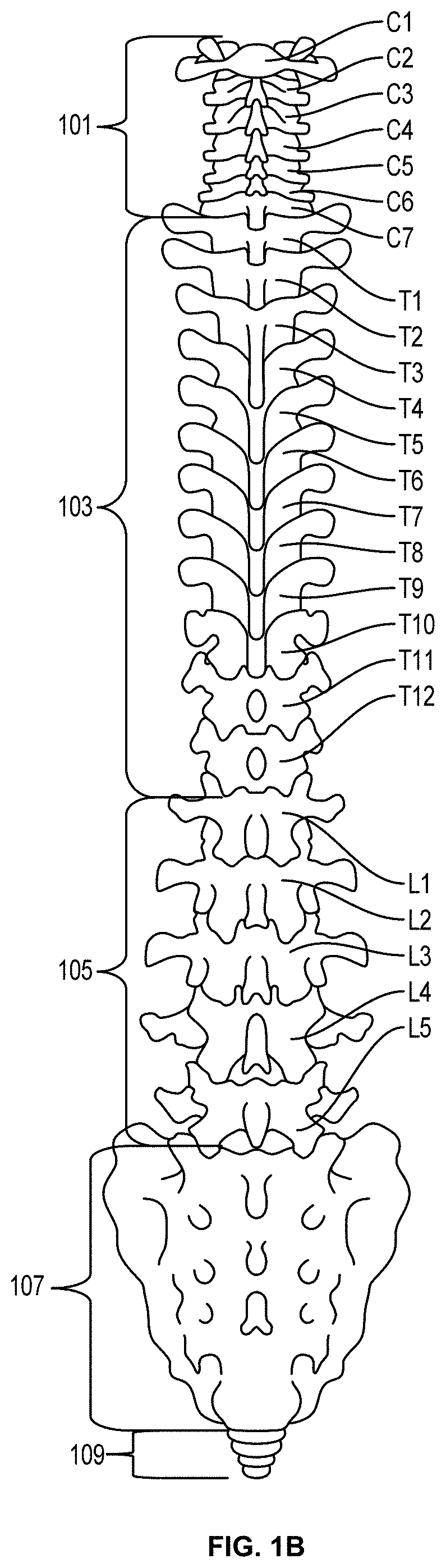 Systems and Methods for Relieving Nerve Tension in Scoliosis