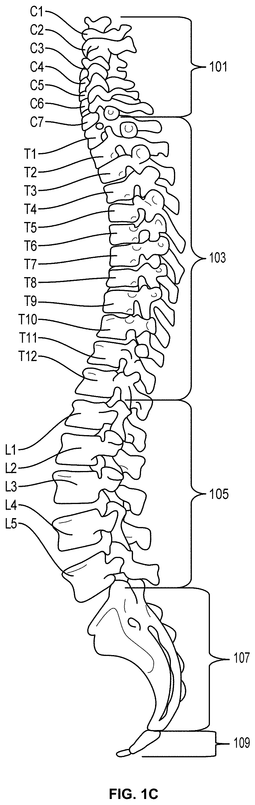 Systems and Methods for Relieving Nerve Tension in Scoliosis