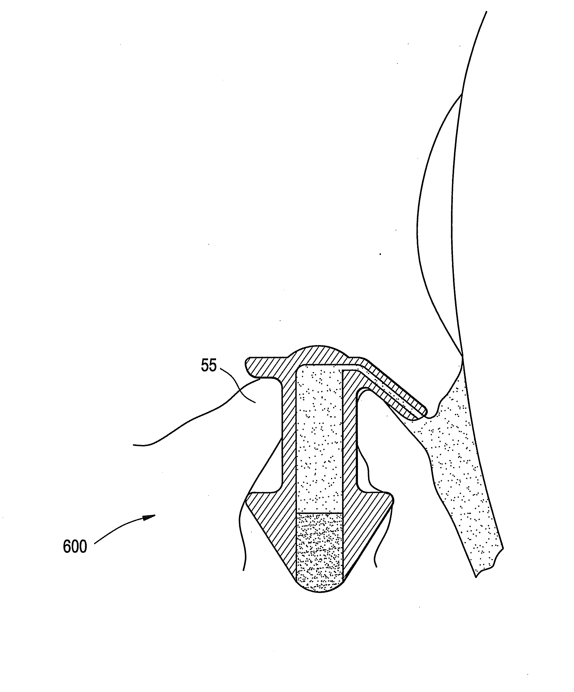 Punctal plugs with directional release