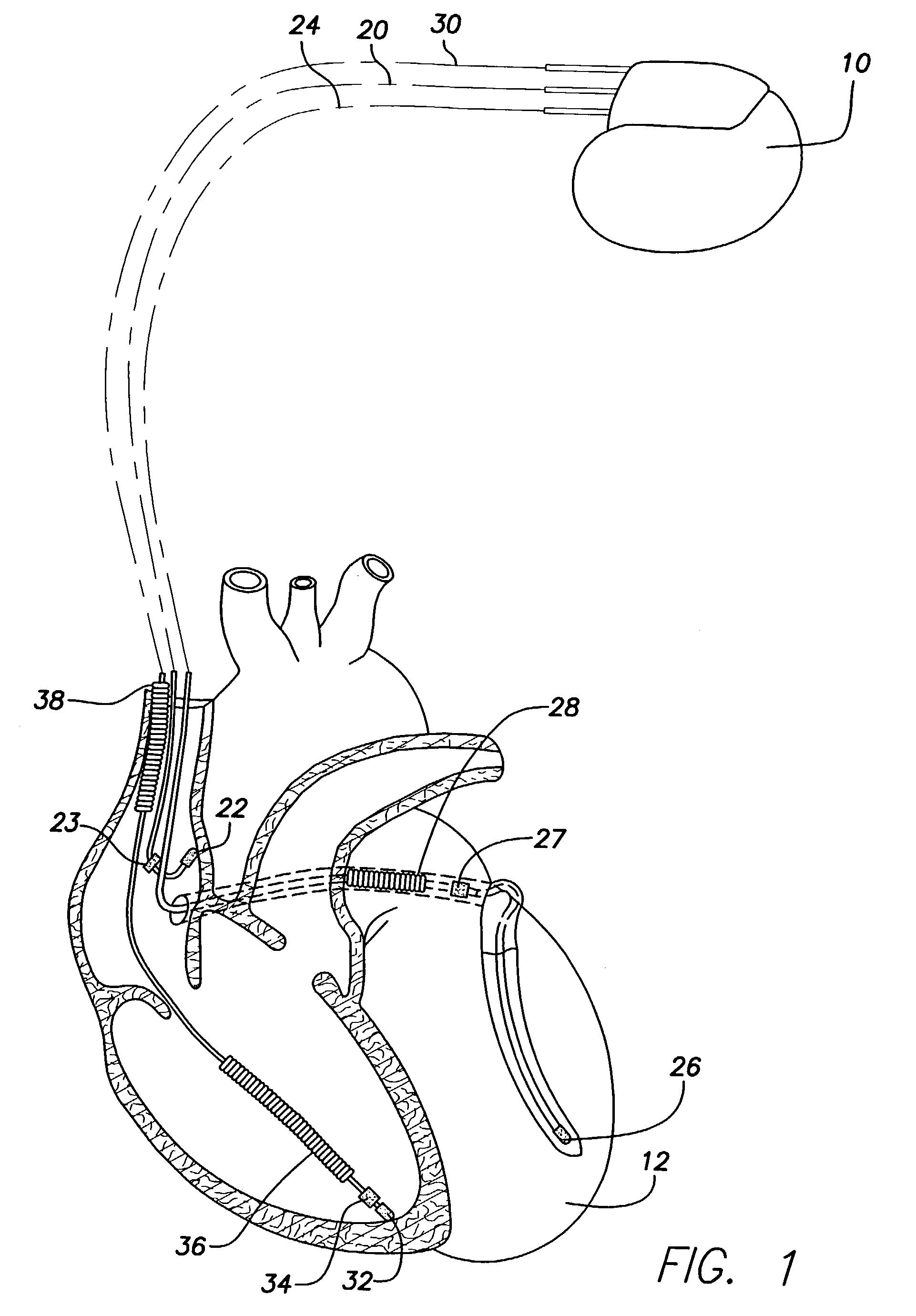 System and method for dynamic ventricular overdrive pacing