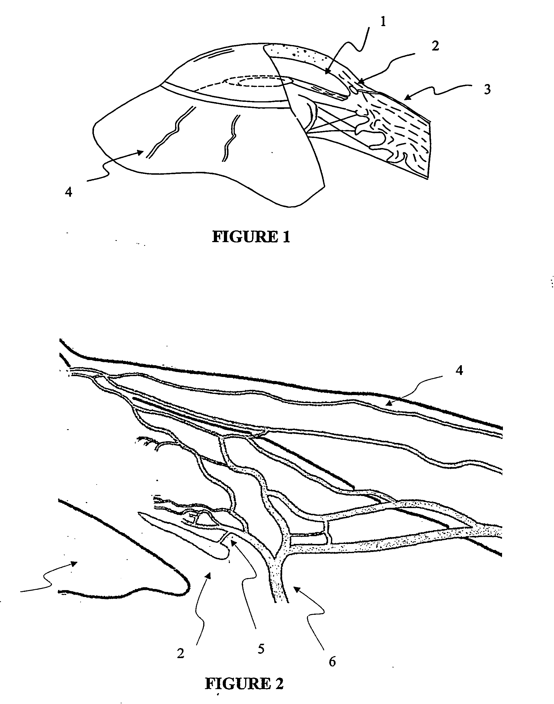 Apparatus and method for surgical bypass of aqueous humor