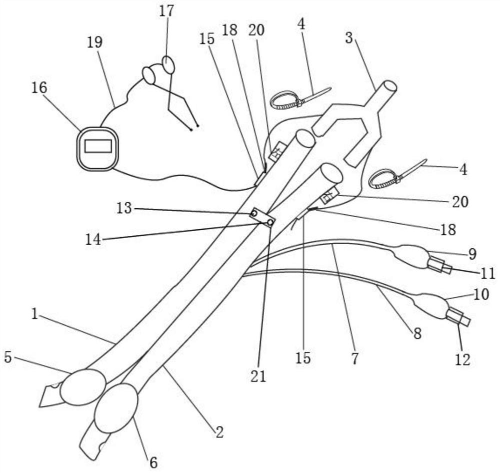 Double-lumen bronchial intubation