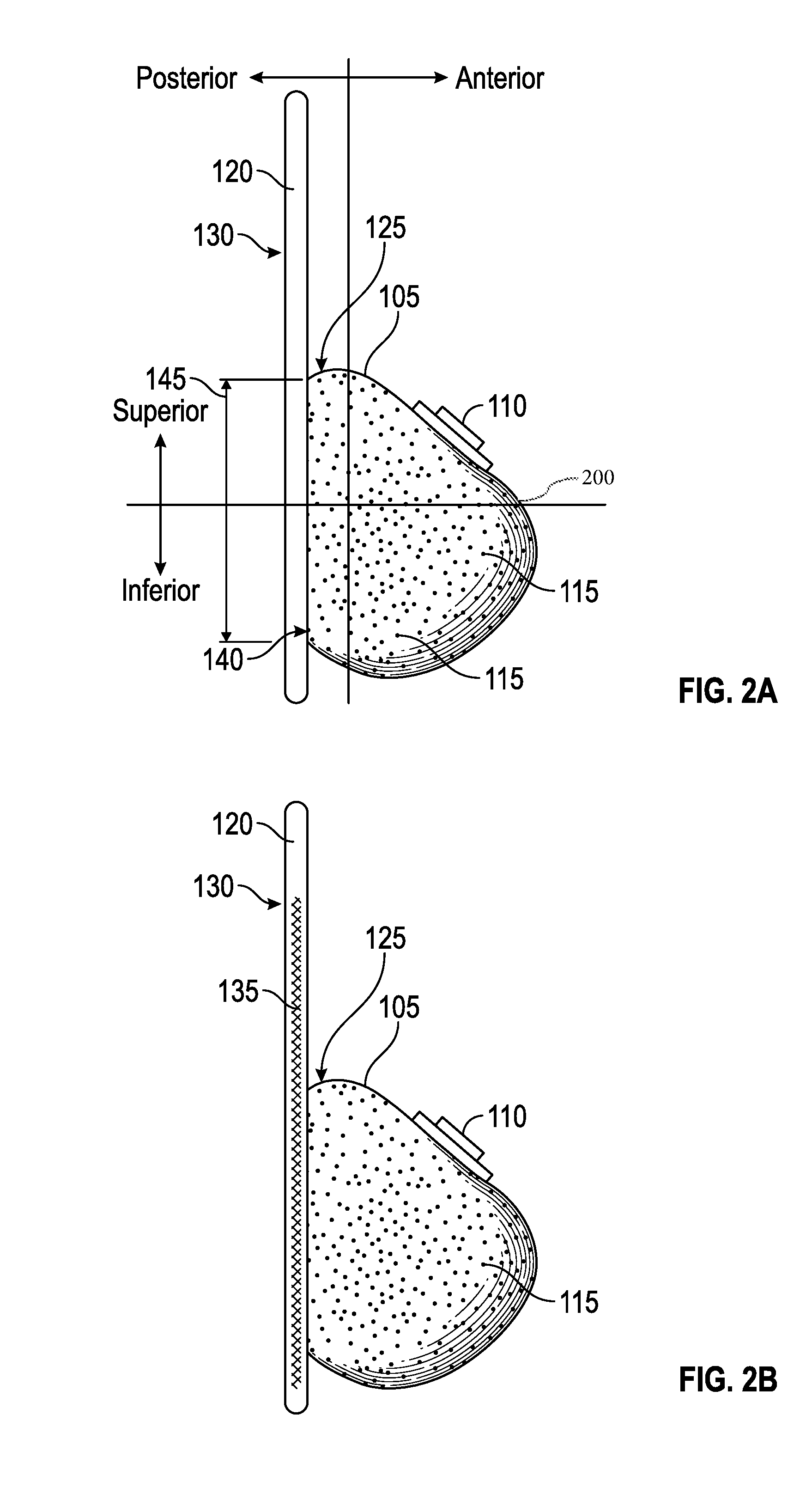 Systems and methods for a tissue expander