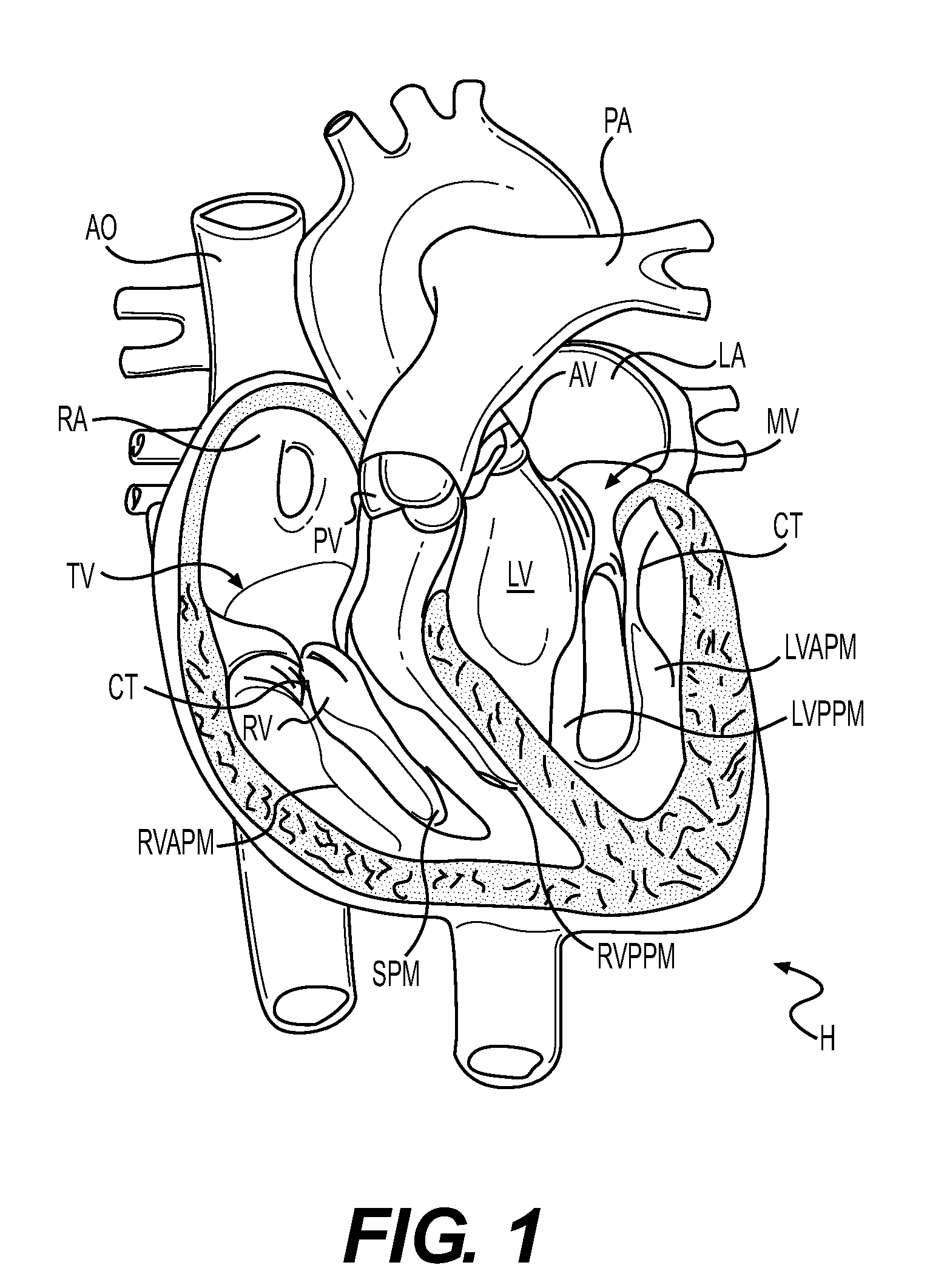 Devices and Methods for Treating a Heart