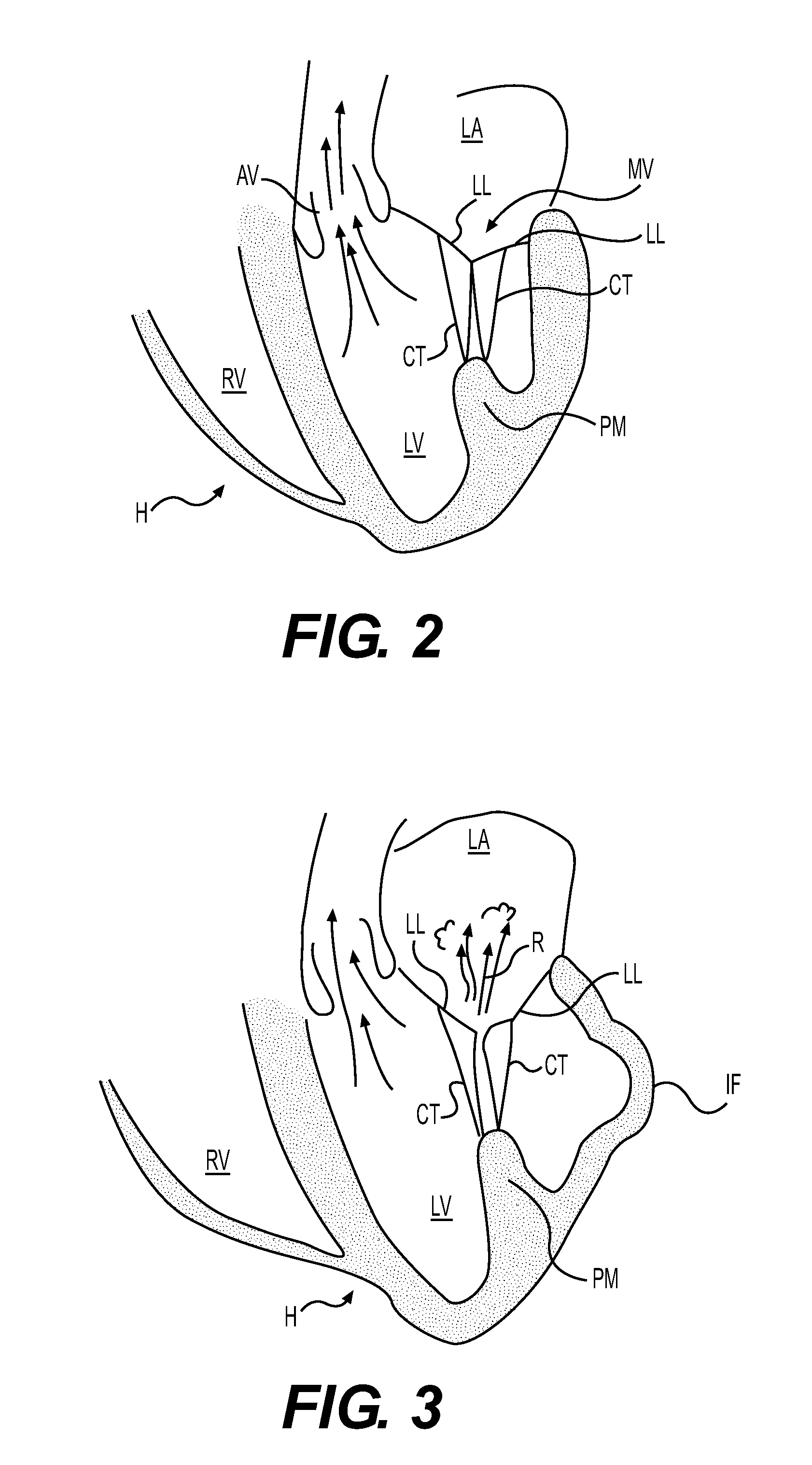 Devices and Methods for Treating a Heart