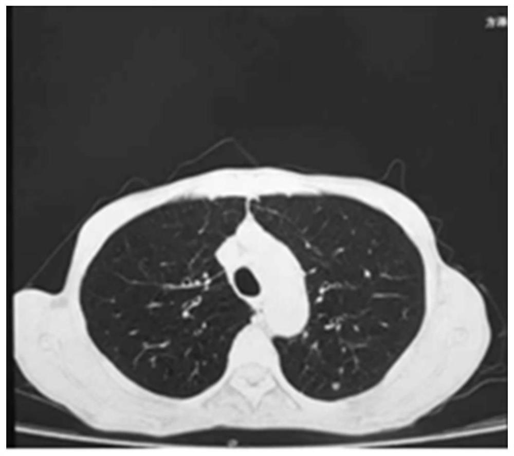 Pharmaceutical composition for treating COPD accompanied by pulmonary fibrosis