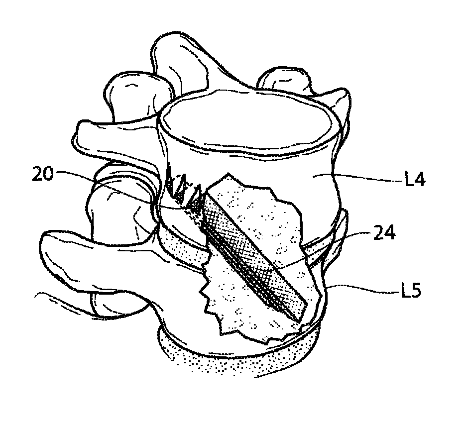 Apparatus, systems, and methods for achieving lumbar facet fusion