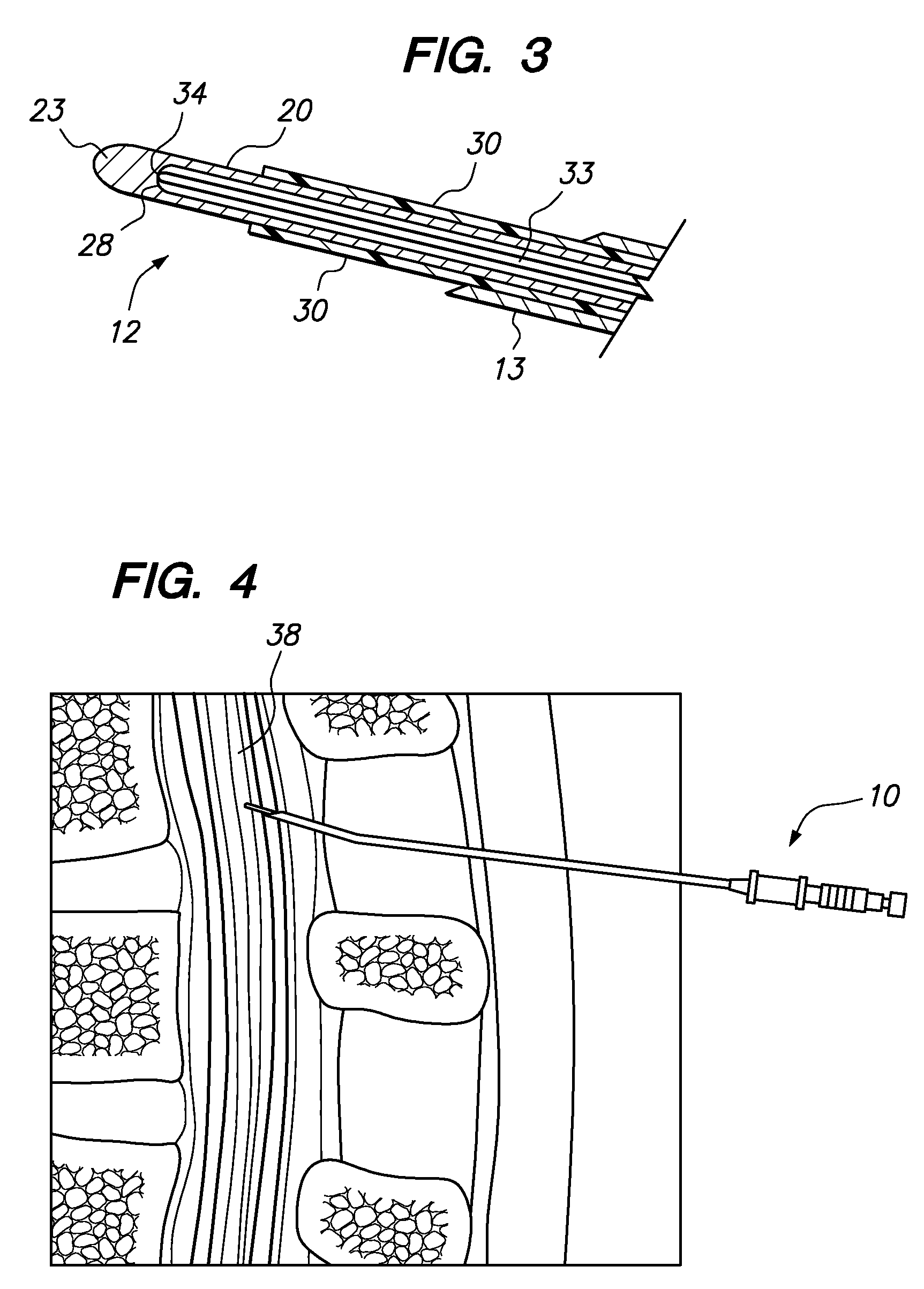 Epidural radiofrequency catheter for effectuating RF treatment in spinal canal and method of using same