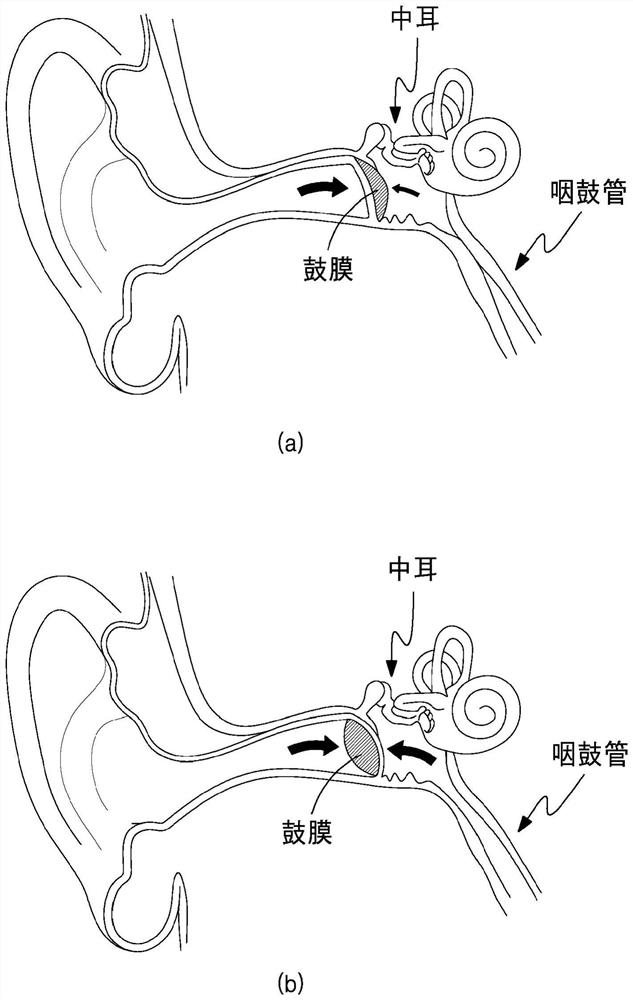Intra-auditory implant stent for treating insufficiency of auditory tube