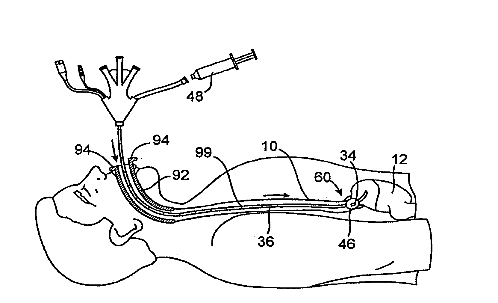 Method and apparatus employing ultrasound energy to treat body sphincters
