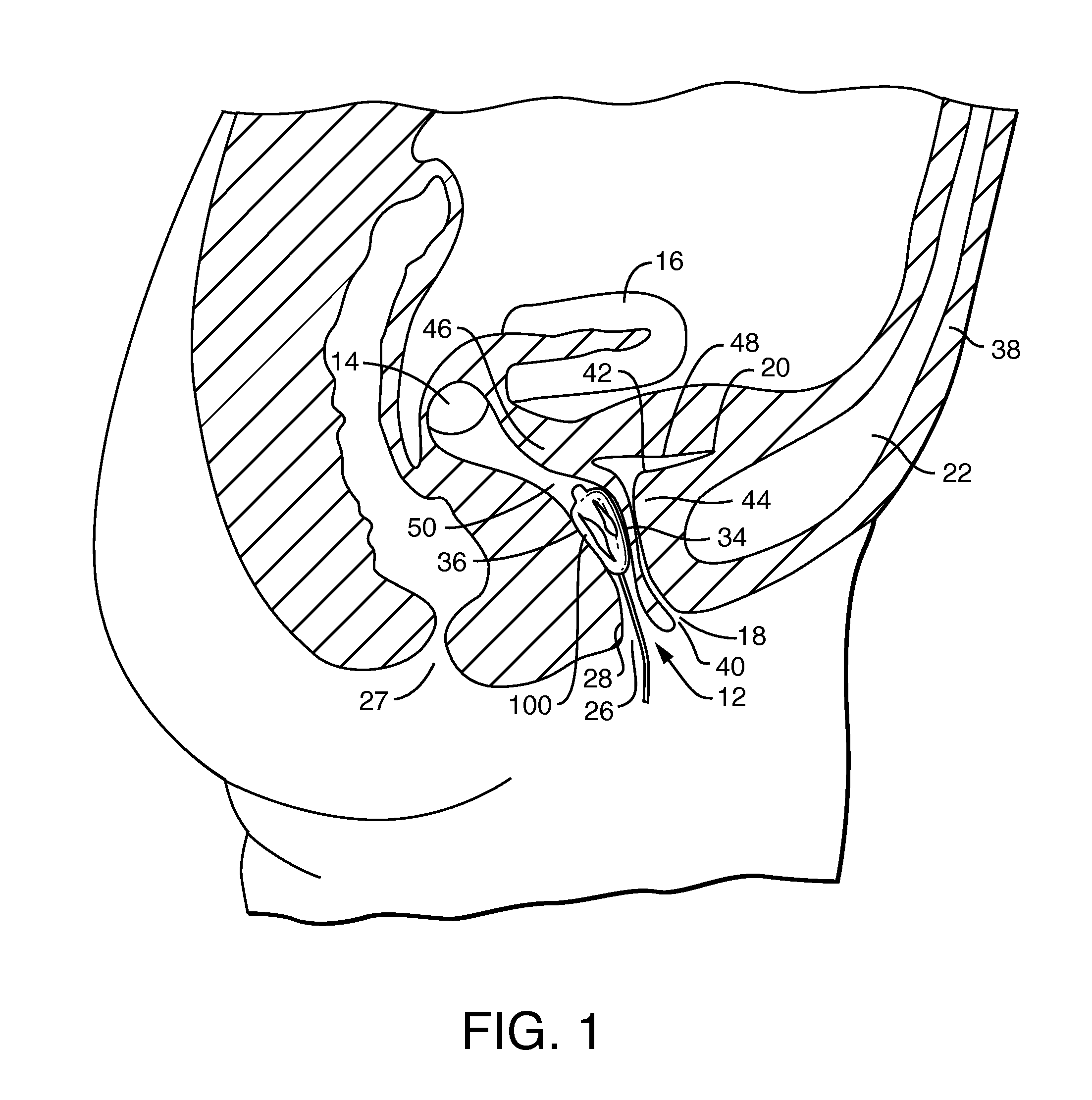 Vaginal Insert Device Having a Support Portion with Plurality of Struts