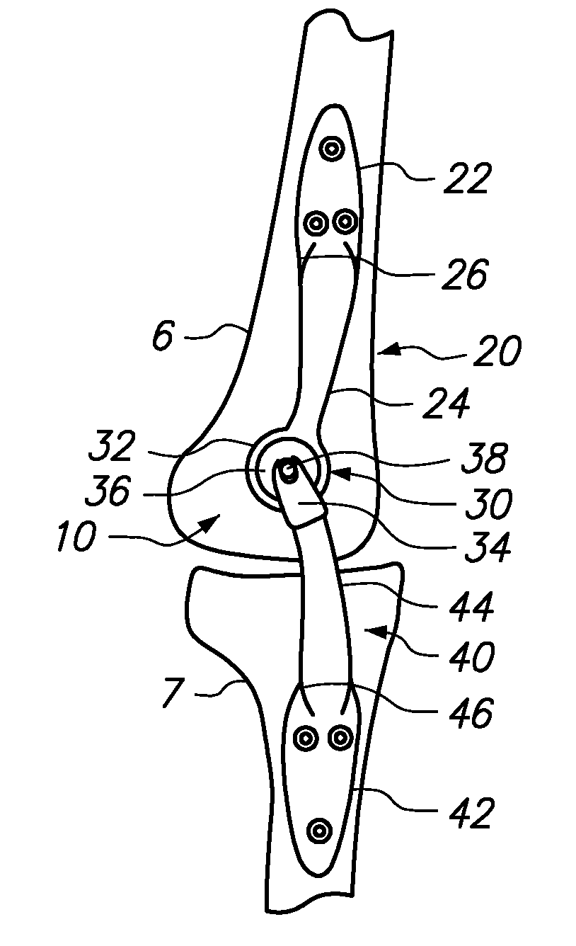 Extra-articular implantable mechanical energy absorbing assemblies having two deflecting members and methods
