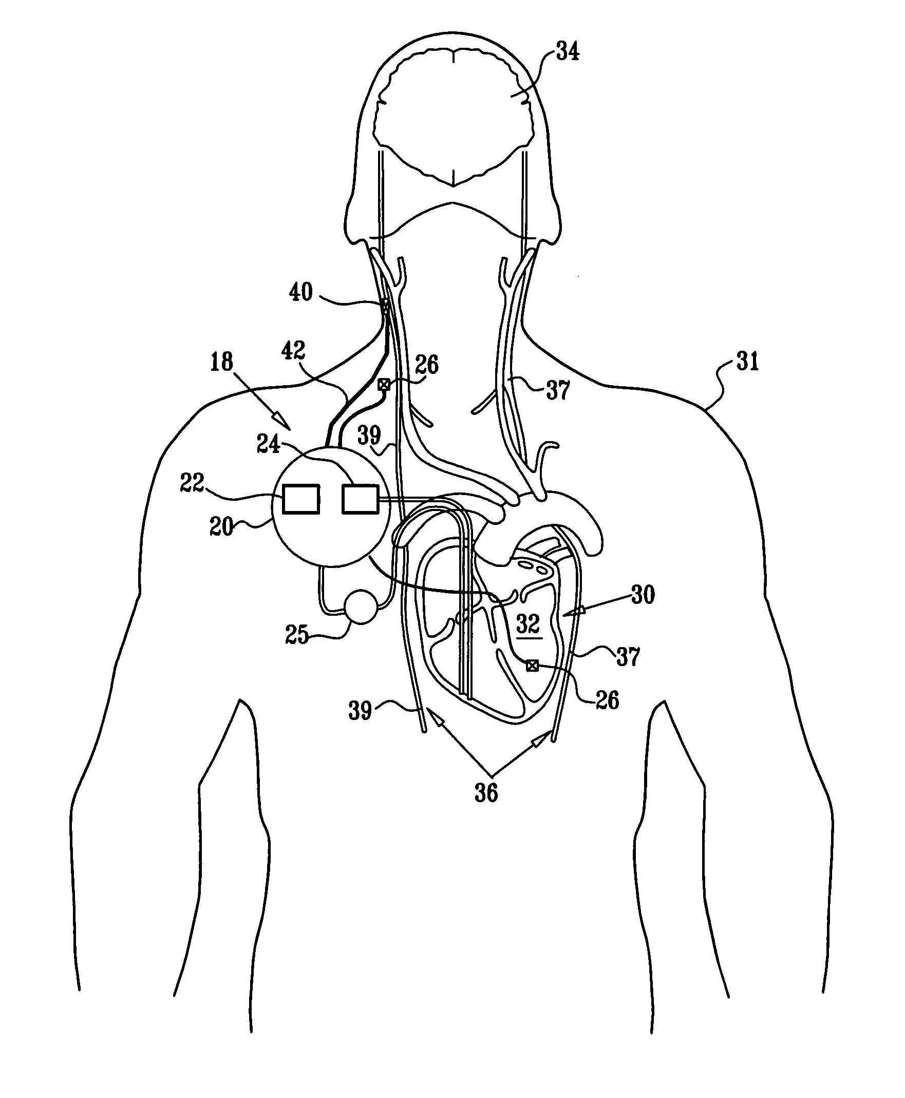 Selective nerve fiber stimulation for treating heart conditions