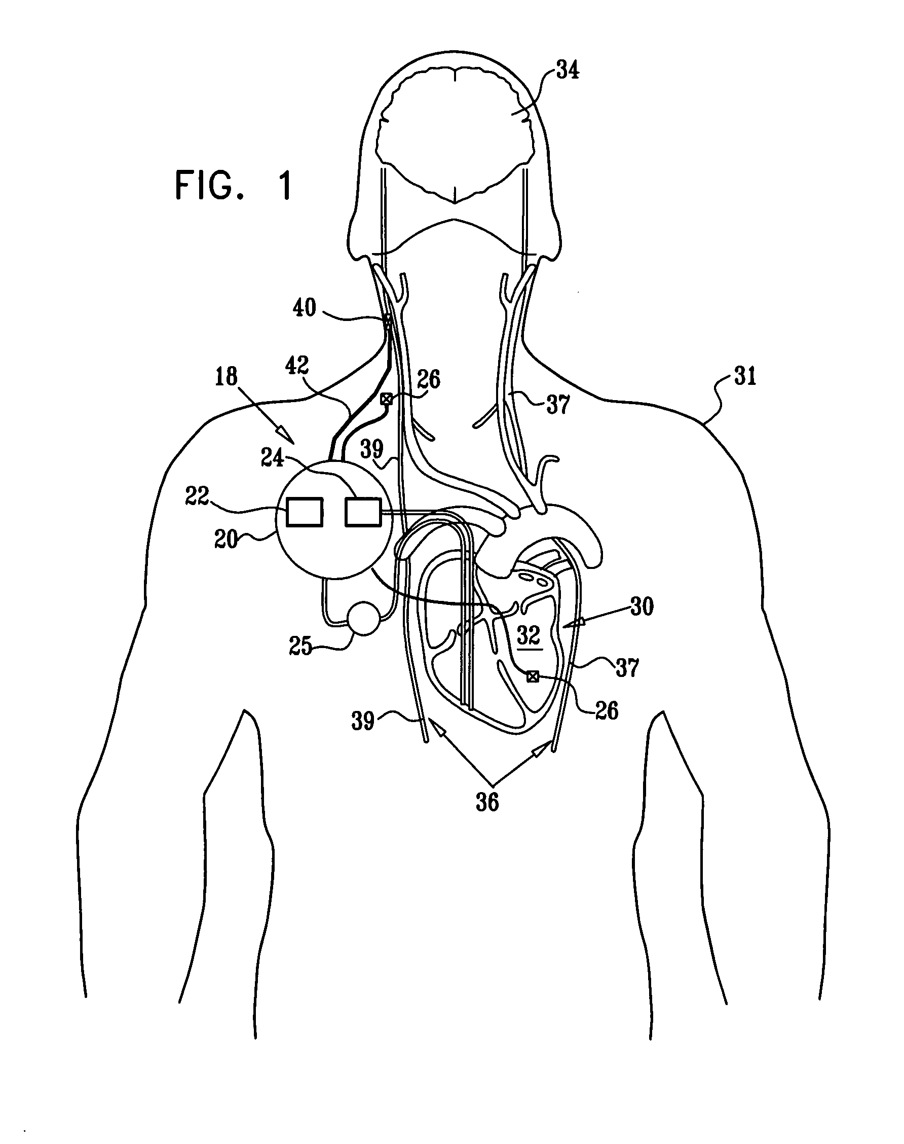 Selective nerve fiber stimulation for treating heart conditions