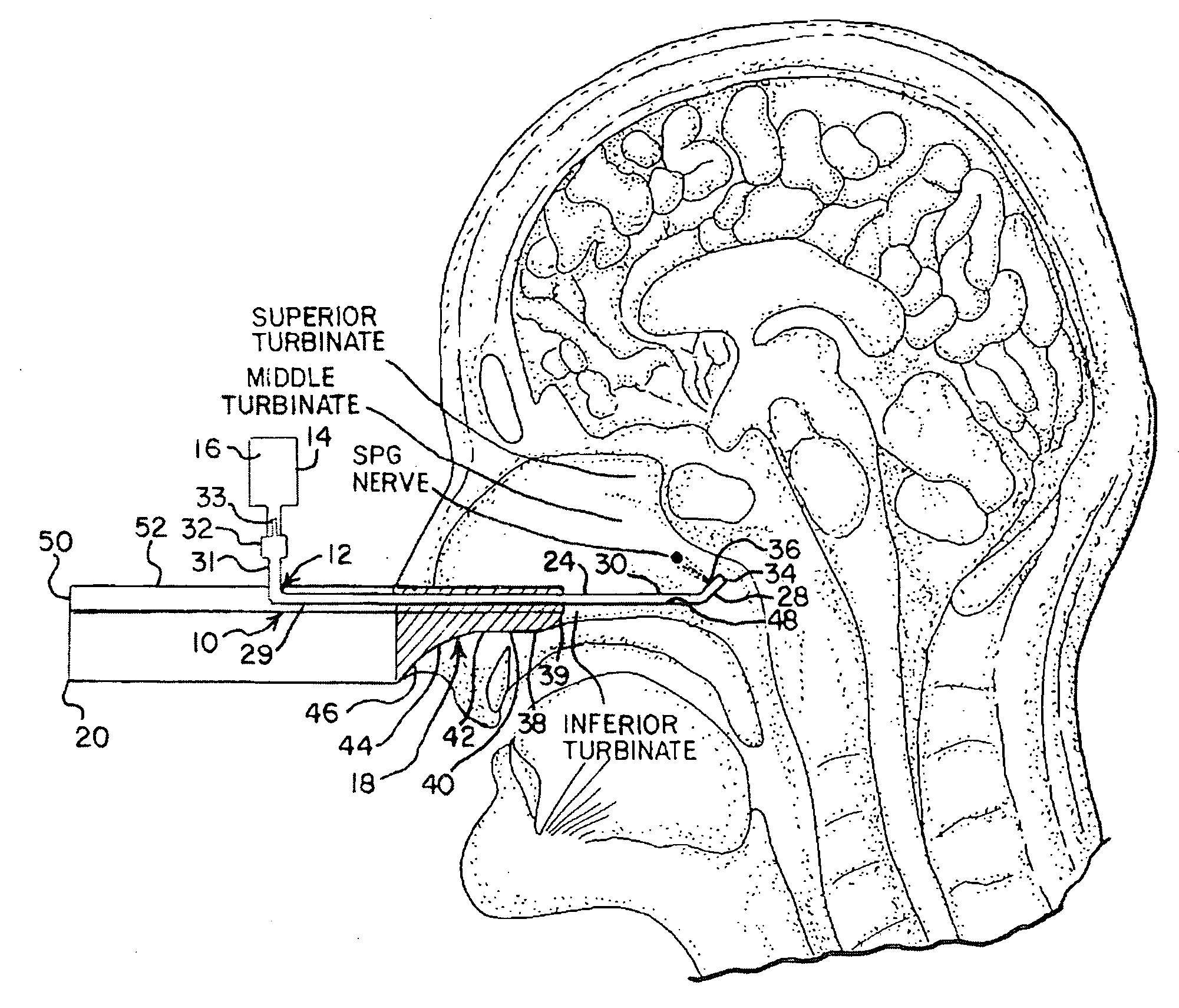 Apparatus and Method for Controlling Headaches