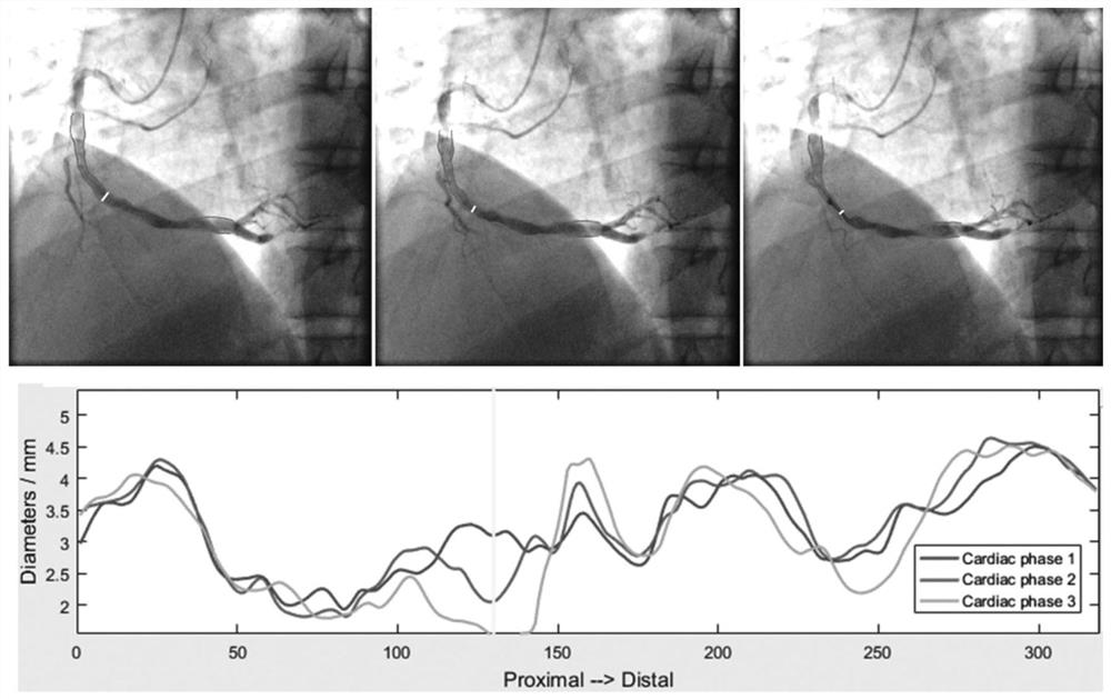 A Simplified Calculation Method and Plaque Rupture Risk Quantification Evaluation System Based on Coronary Multimodal Image Crack Formation and Extension