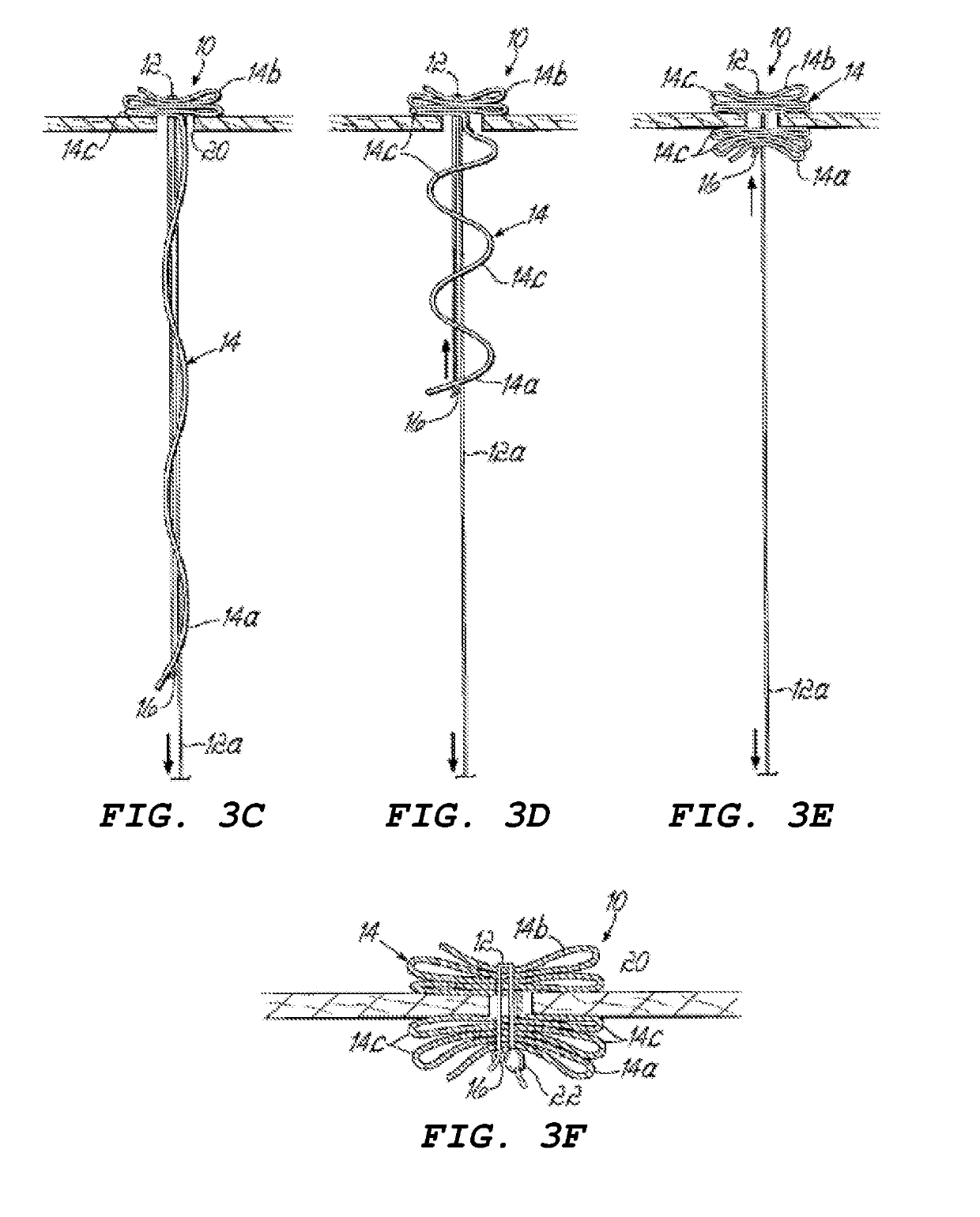 Devices for treating paravalvular leakage and methods use thereof