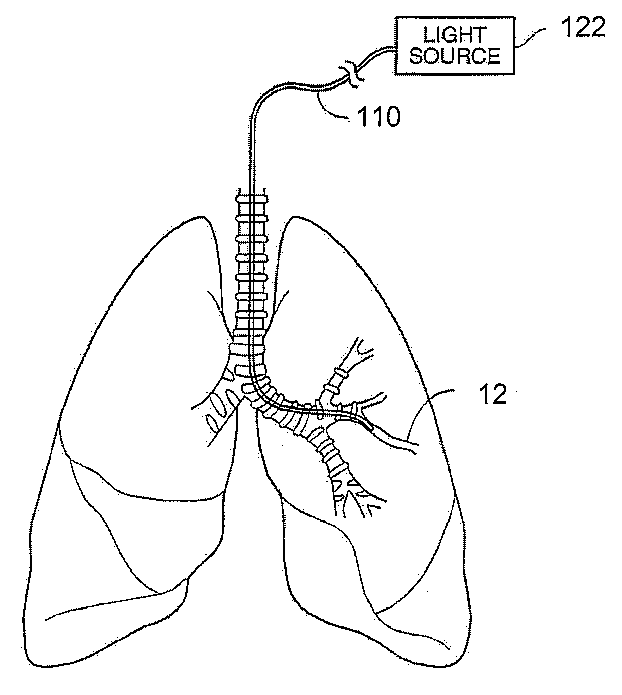 Apparatus for treating airways in the lung