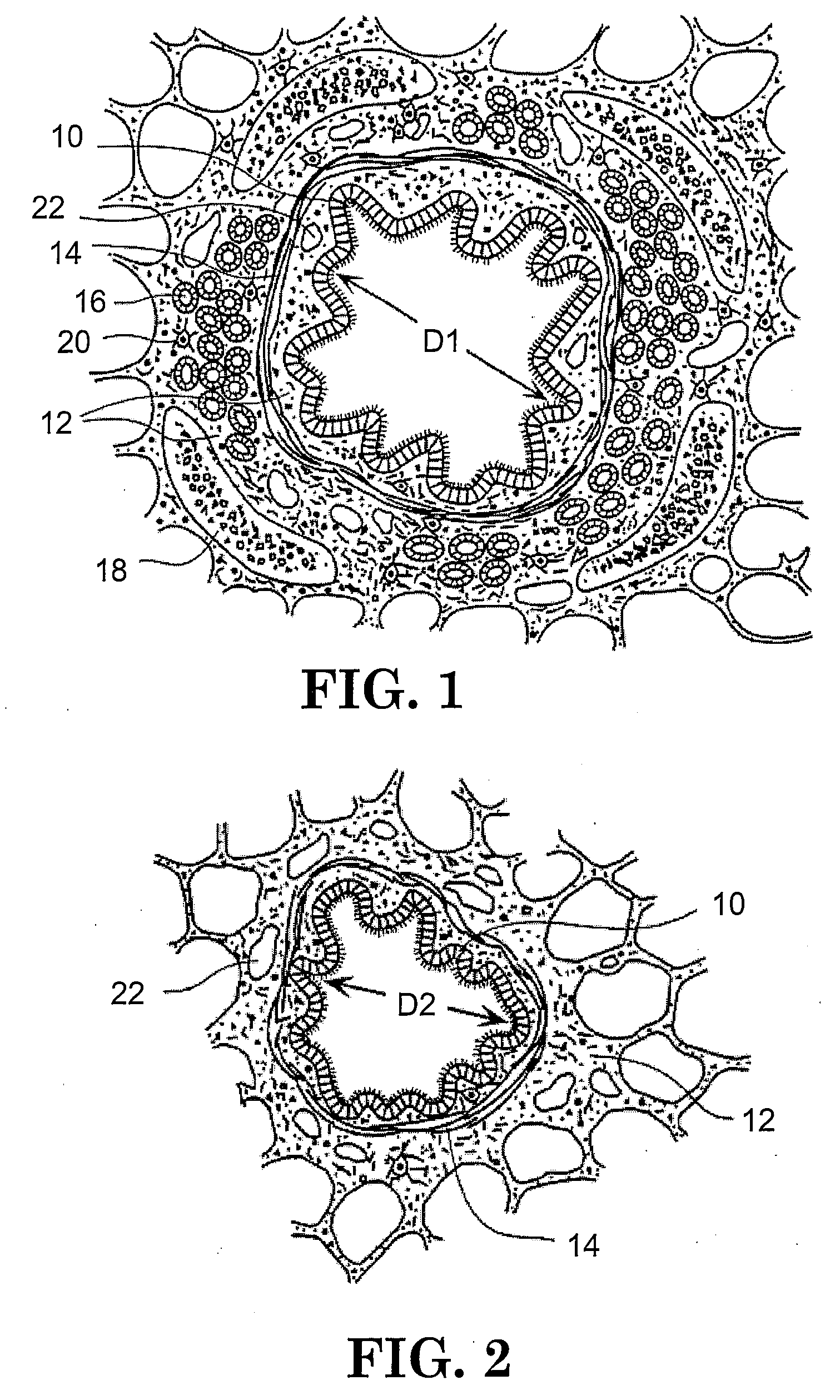 Apparatus for treating airways in the lung
