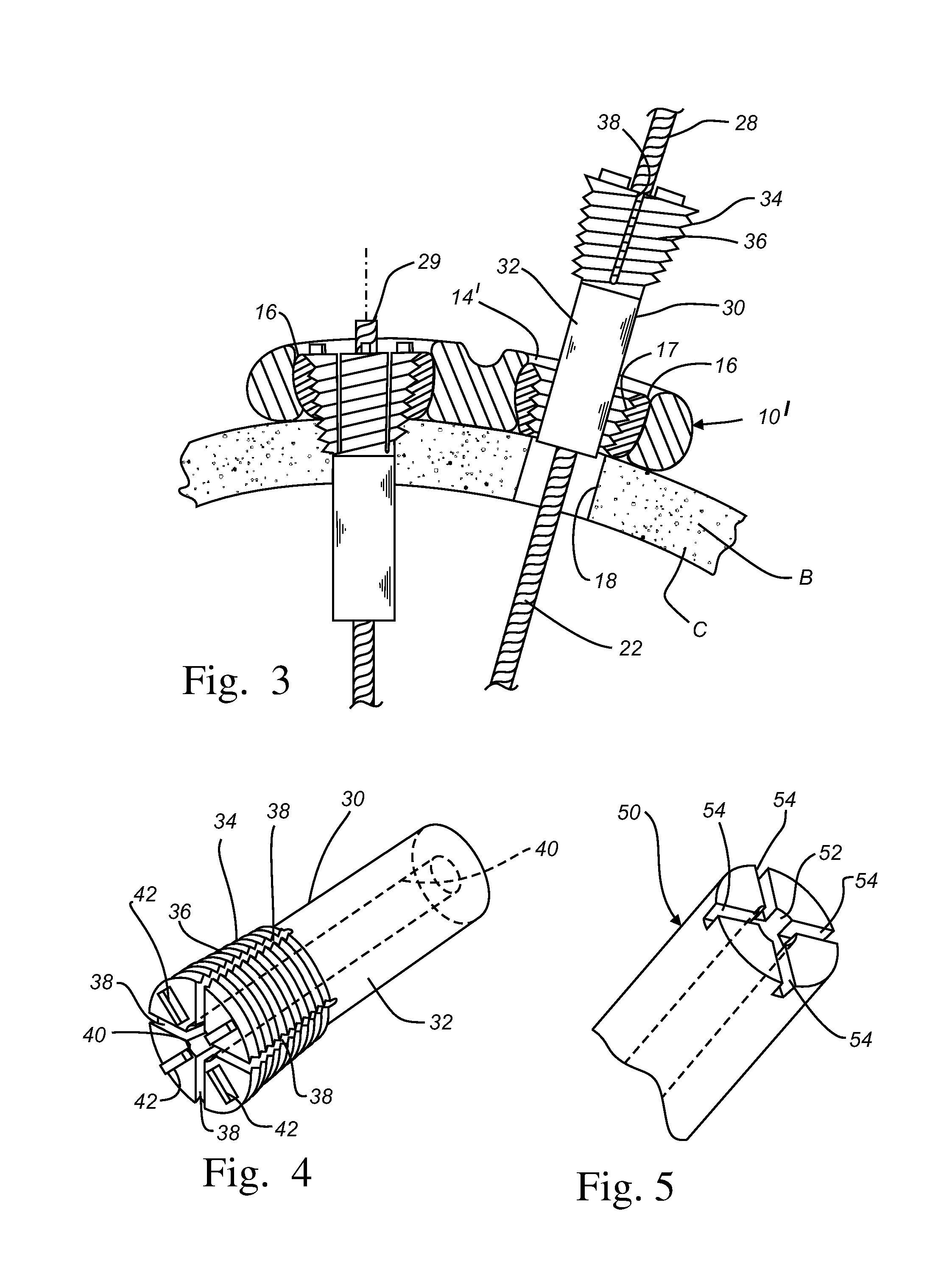 Fastening system for internal fixation