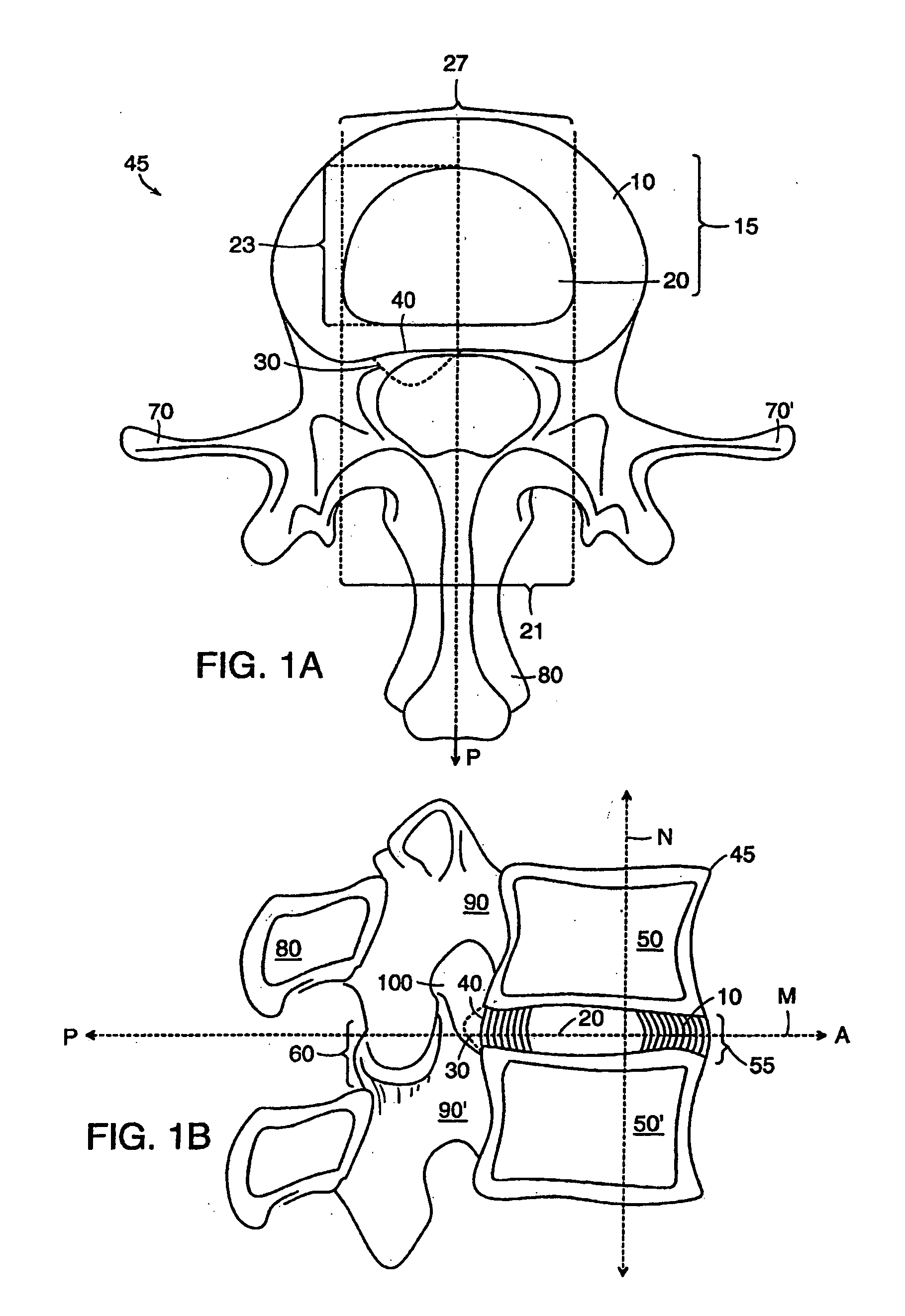 Method of implanting a dynamically stable spinal implant