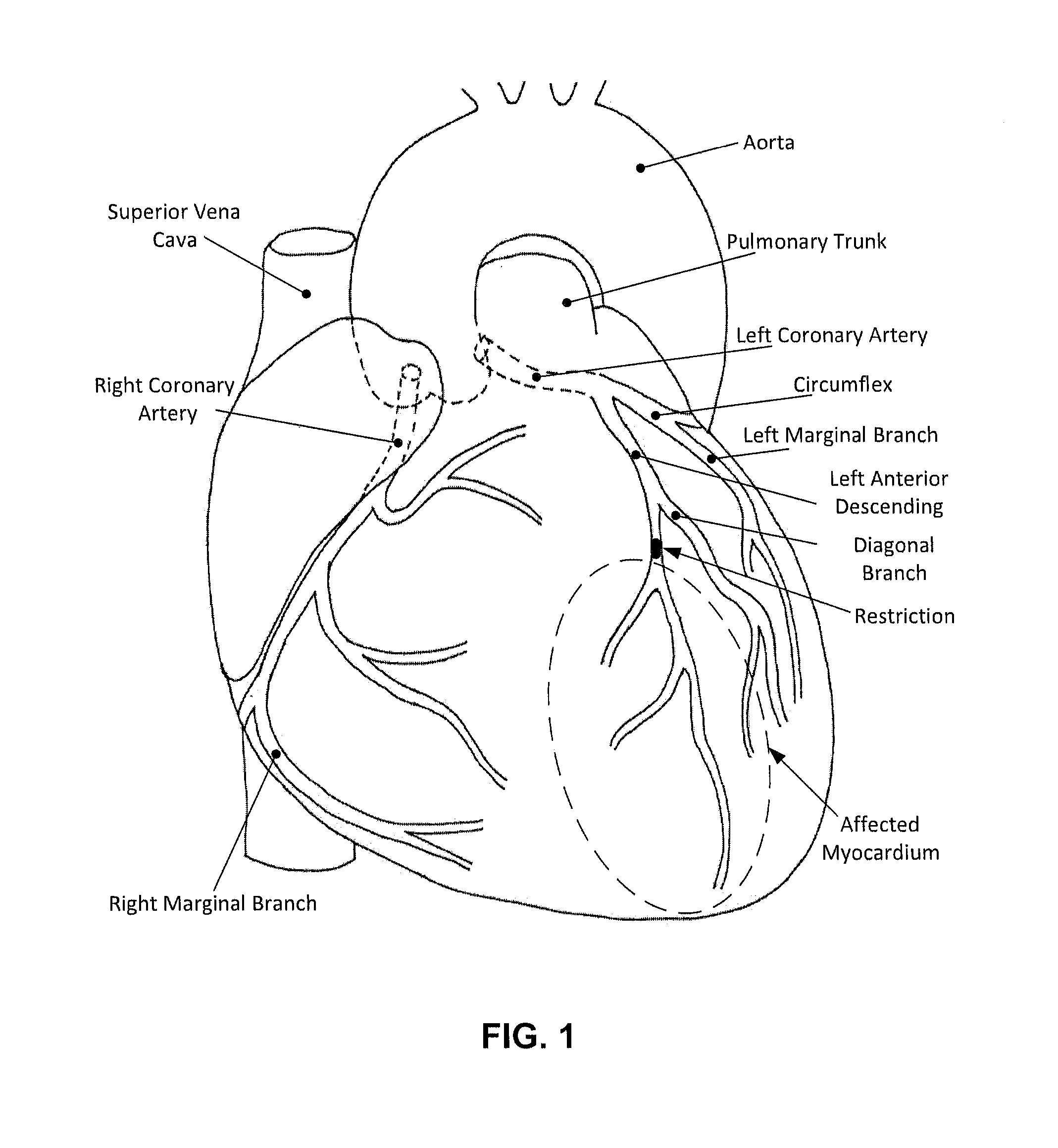 Devices and methods to reduce myocardial reperfusion injury