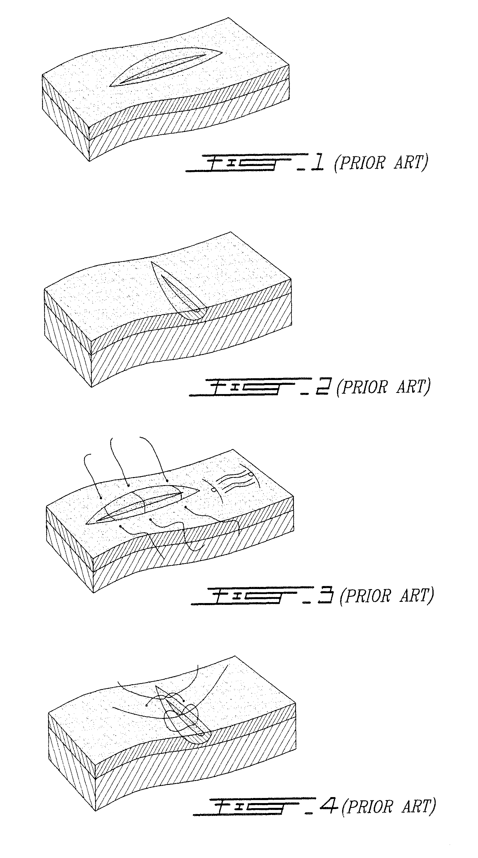 Biodegradable suture clip for joining bodily soft tissue