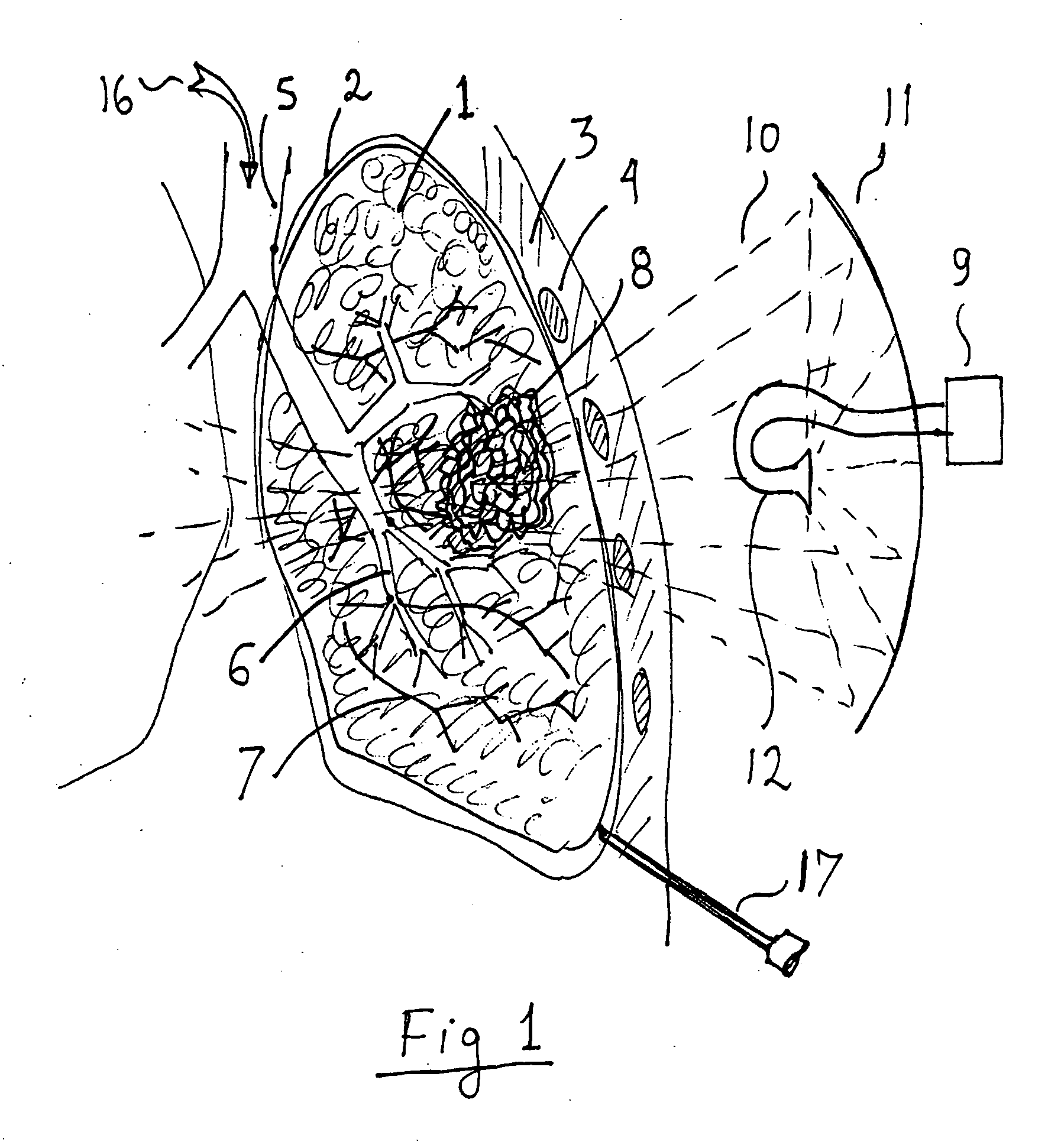 System for treating undesired body tissue