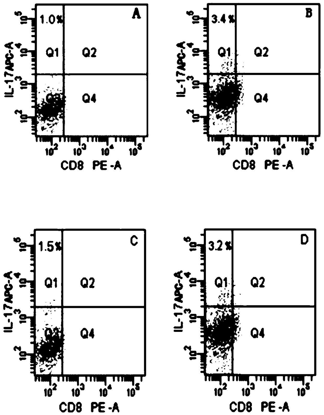 Interference sequence of IL-17 gene closely related to primary nephrotic syndrome podocyte injury