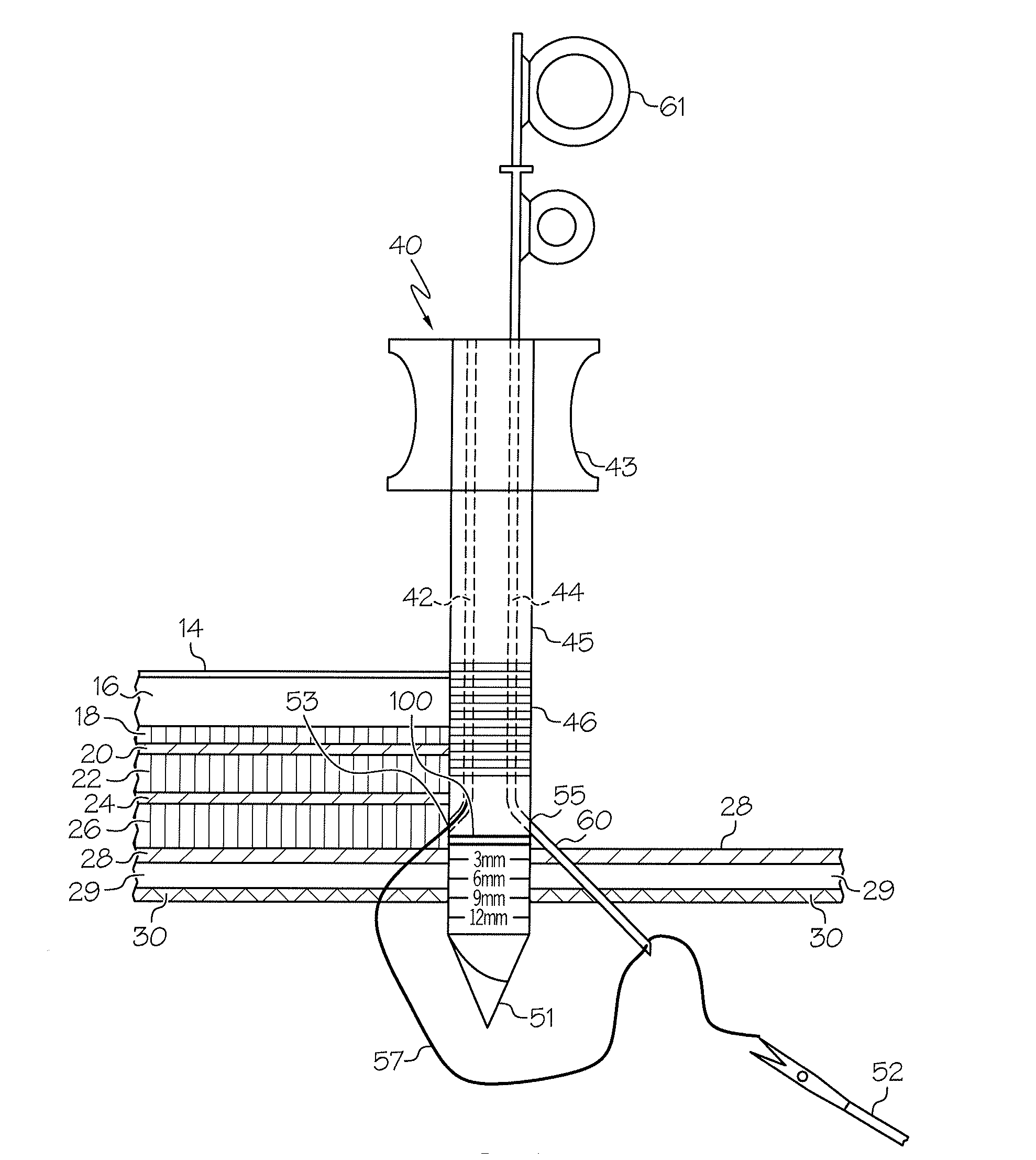 Laparoscopic wound closure device