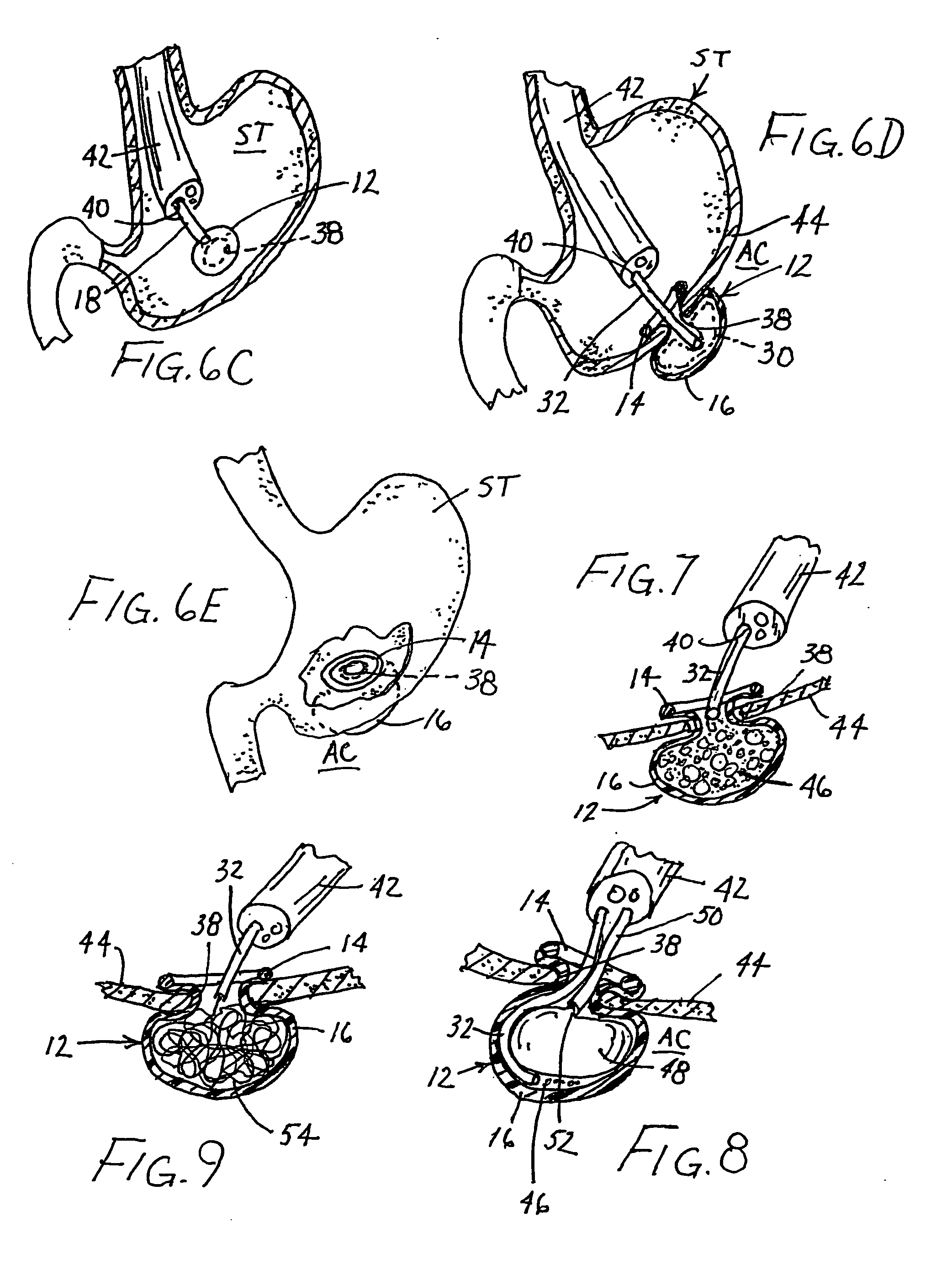 Surgical kit, closure device, and associated method