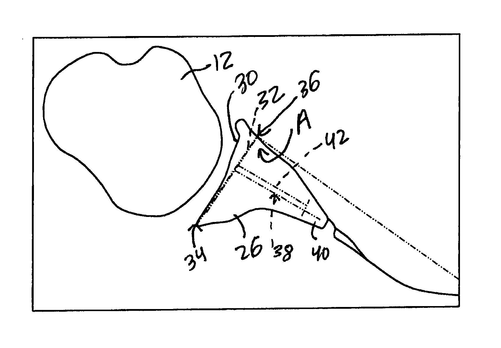 Method for optimization of joint arthroplasty component design