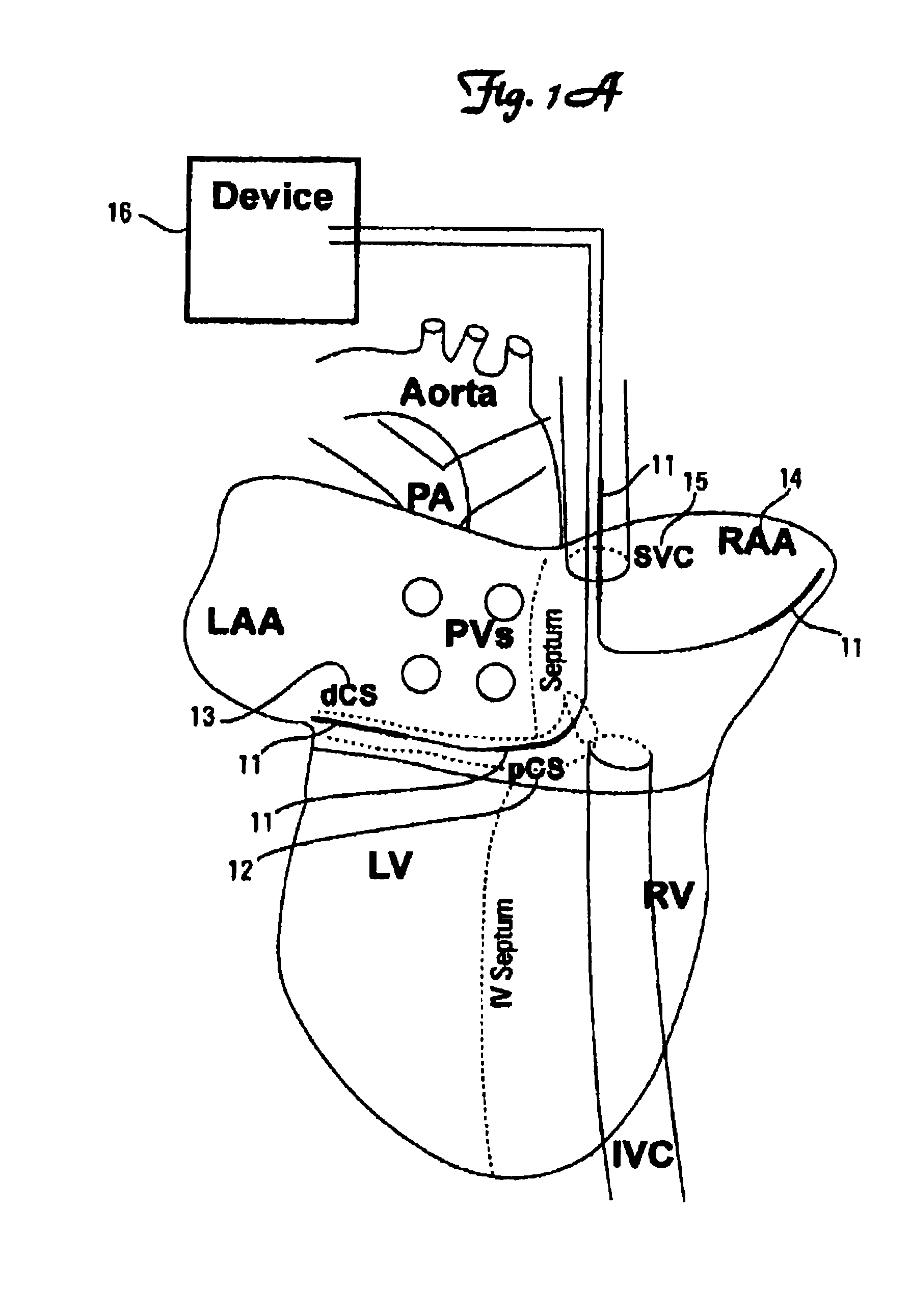 Method and device for three-stage atrial cardioversion therapy
