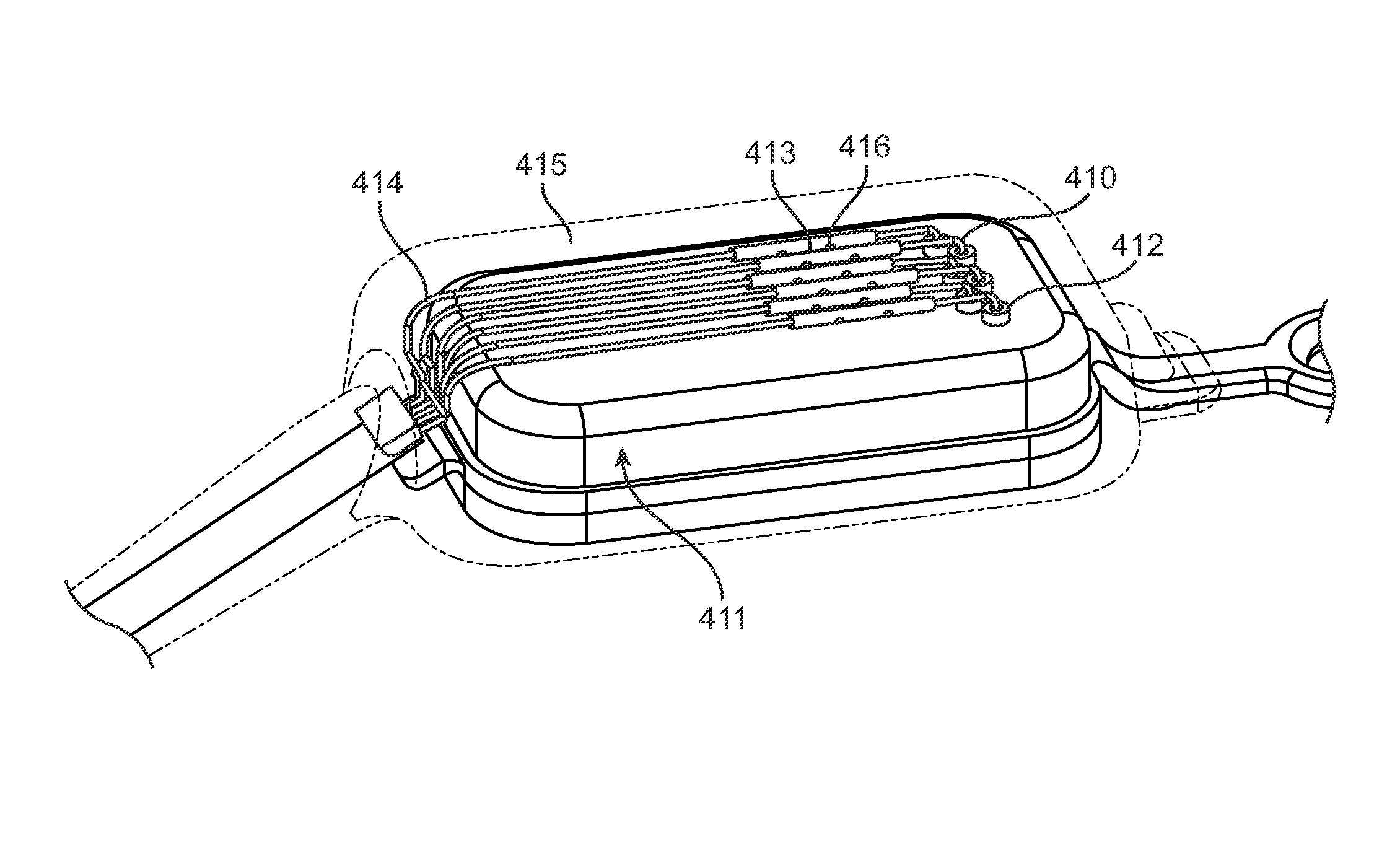 Implantable neurostimulator with integral hermetic electronic enclosure, circuit substrate, monolithic feed-through, lead assembly and anchoring mechanism