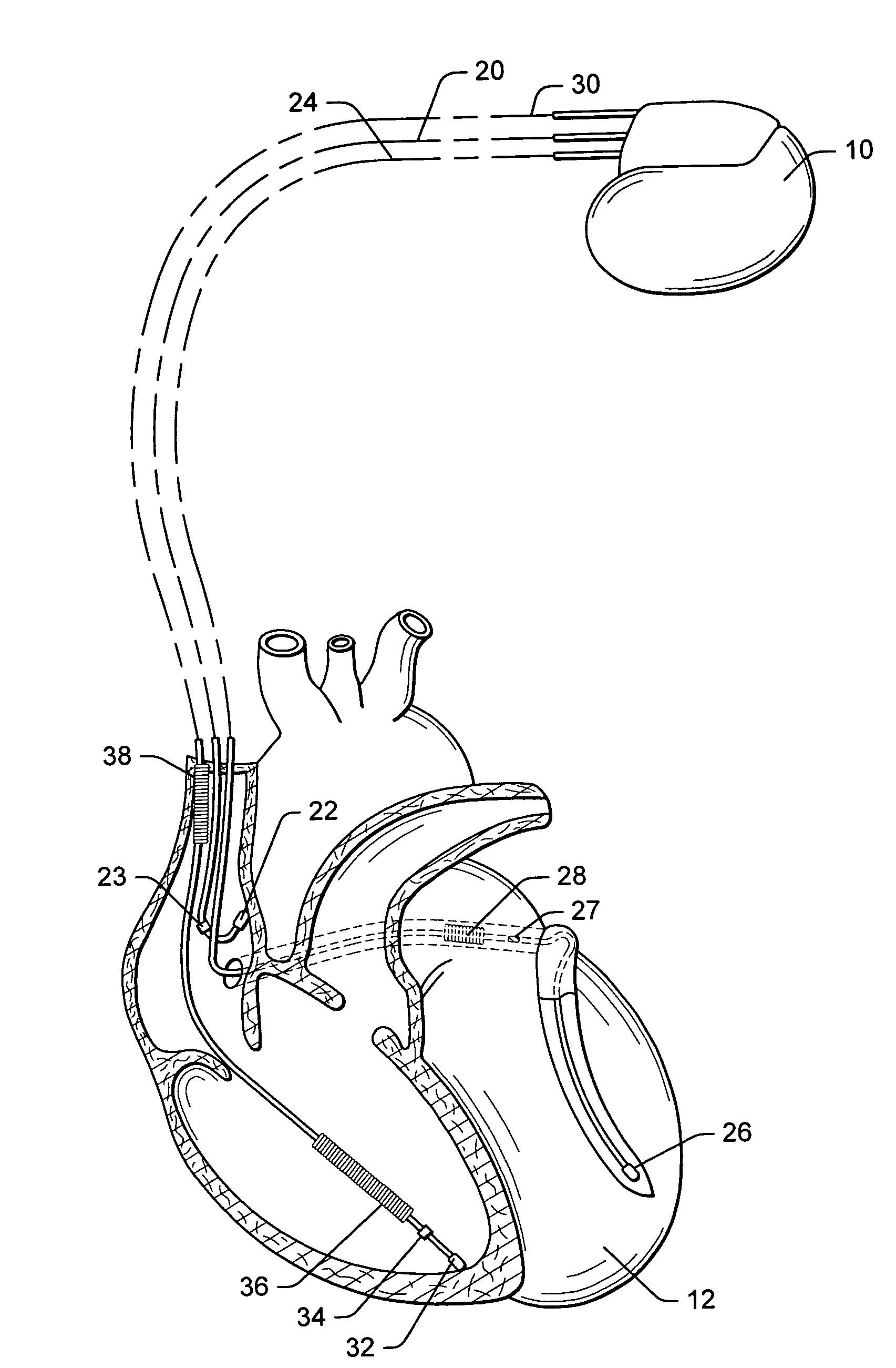 System and method for rapid optimization of control parameters of an implantable cardiac stimulation device