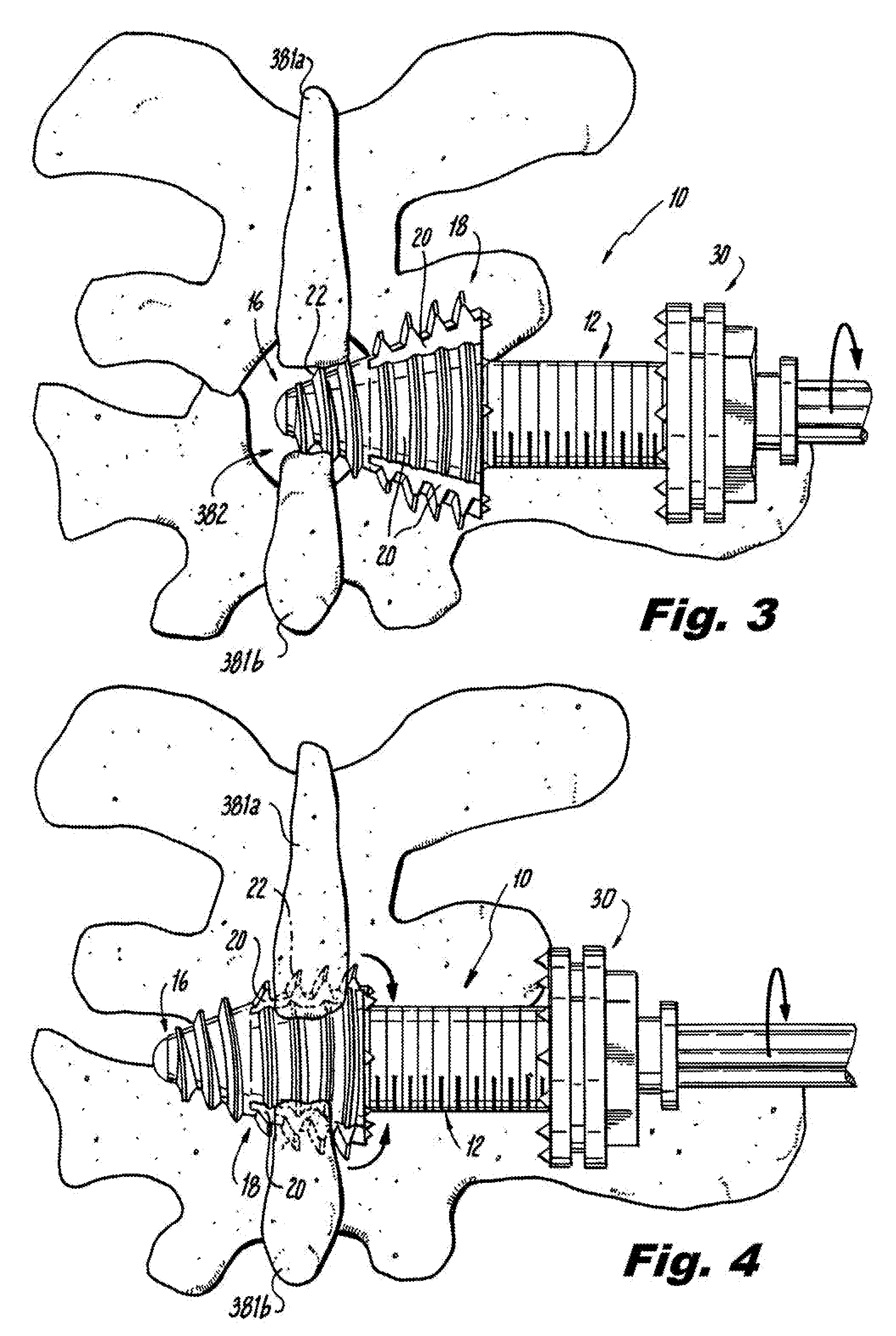 Interspinous Process Implant and Fusion Cage Spacer