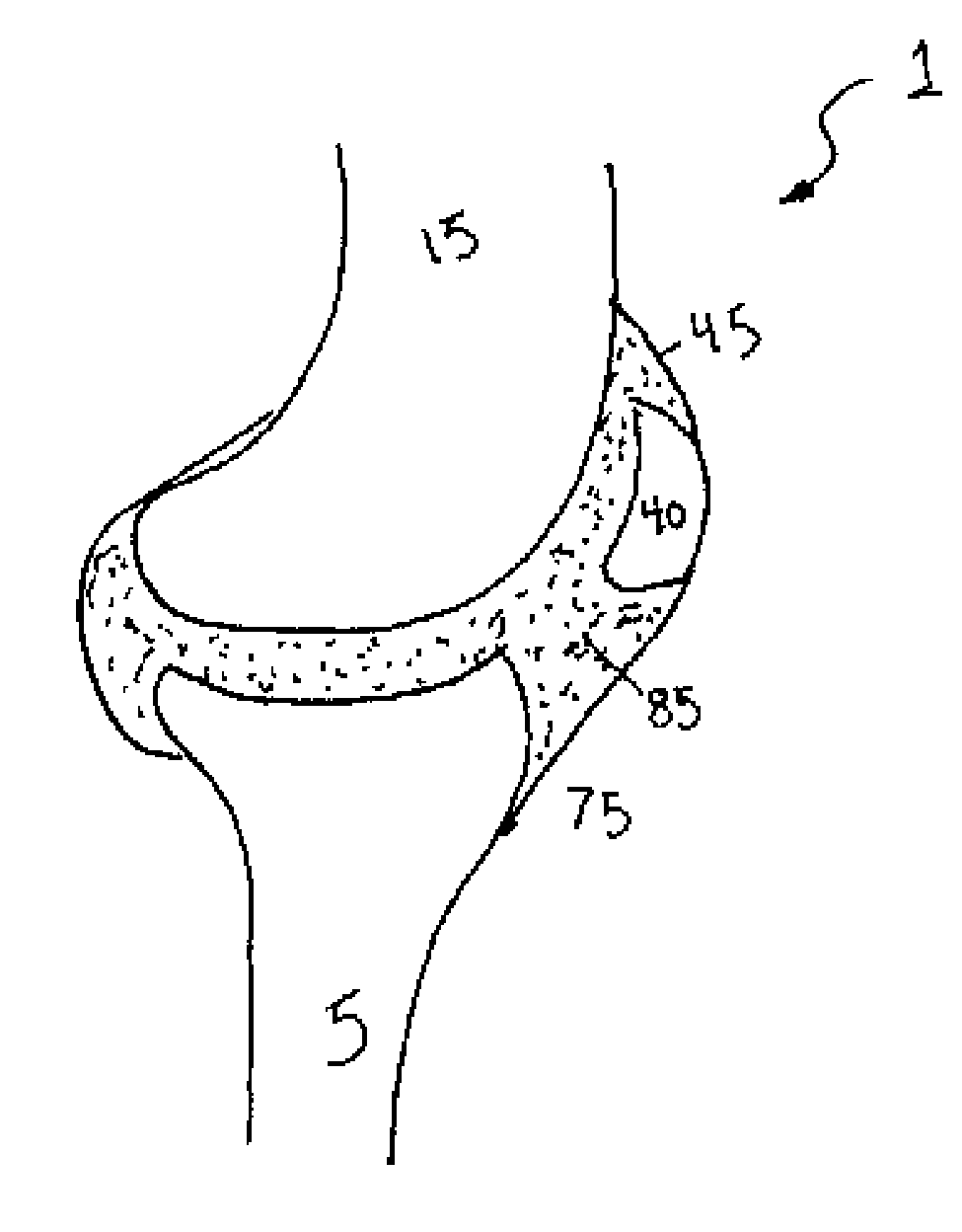 Method and apparatus for delivering treatment to a joint