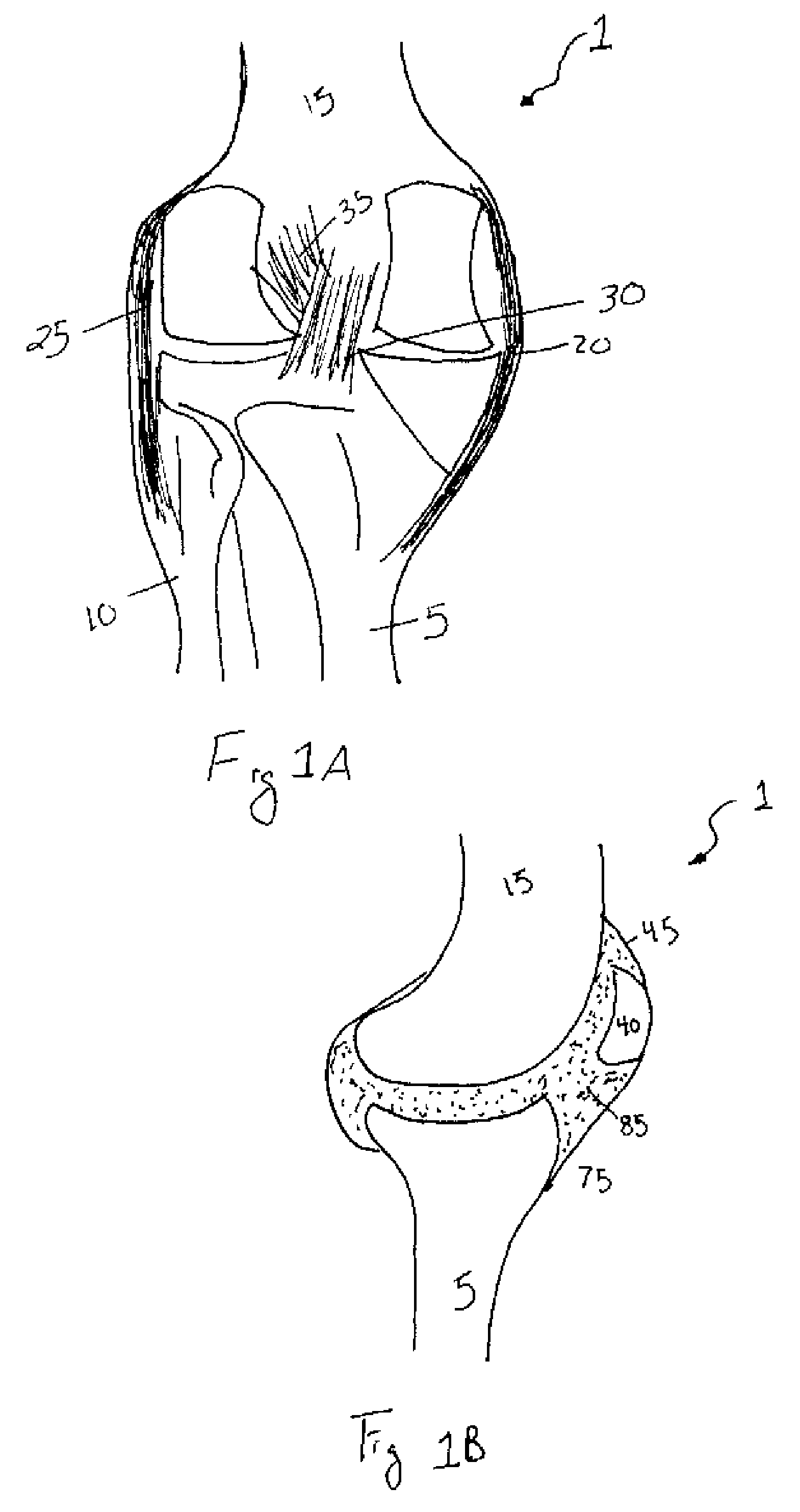 Method and apparatus for delivering treatment to a joint